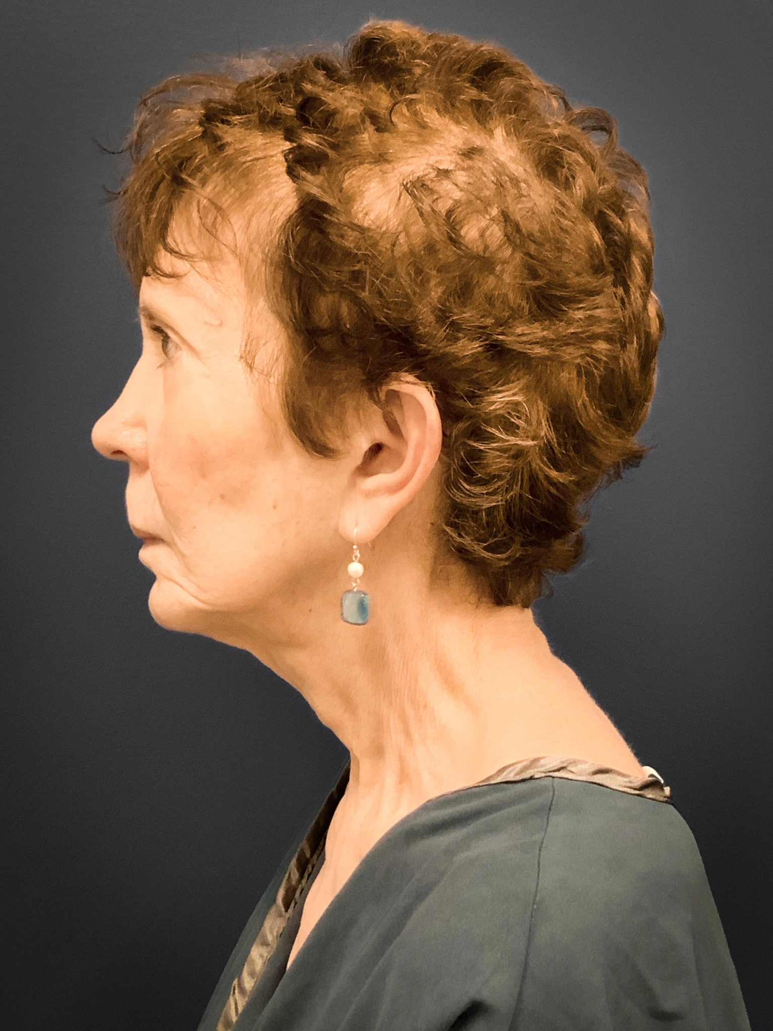 Facelift-and-Facial-Fat-Grafting-Case--5079 | Before Facial Fat Grafting 2
