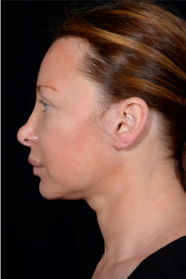 Facelift-and-Facial-Fat-Grafting-Case--1679 | Before Facelift 2