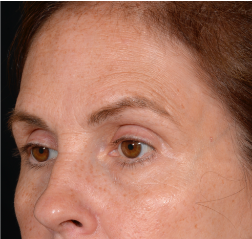 Quad-Blepheroplasty-Case--5361 | Before Eyelid Surgery 3