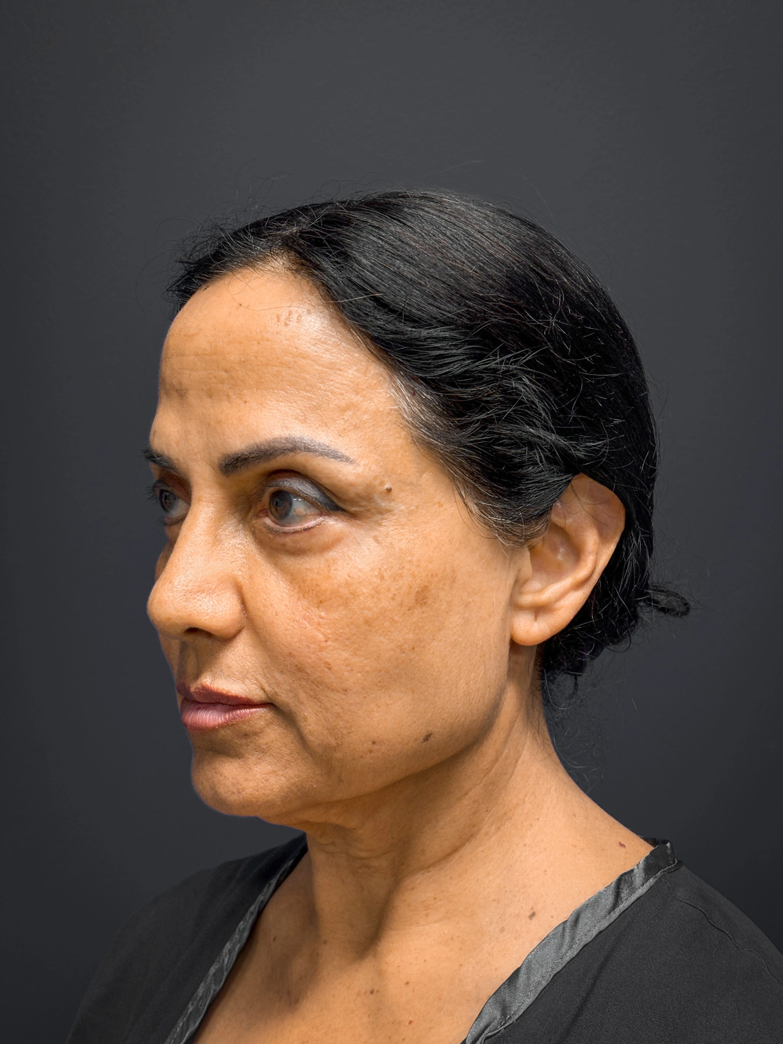 Facelift-and-Facial-Fat-Grafting-Case--8416 | Before Facelift 5