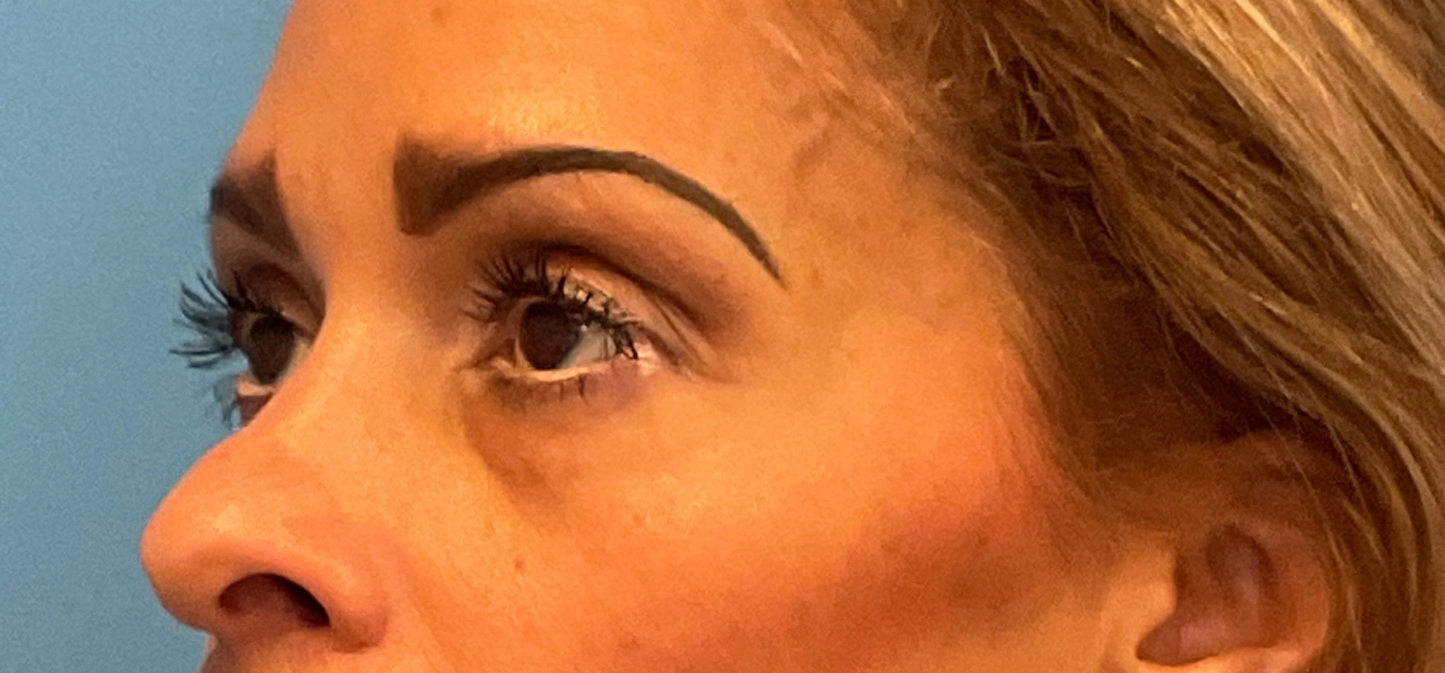 Quad-Blepharoplasty-Case--1261 | Before Eyelid Surgery 5