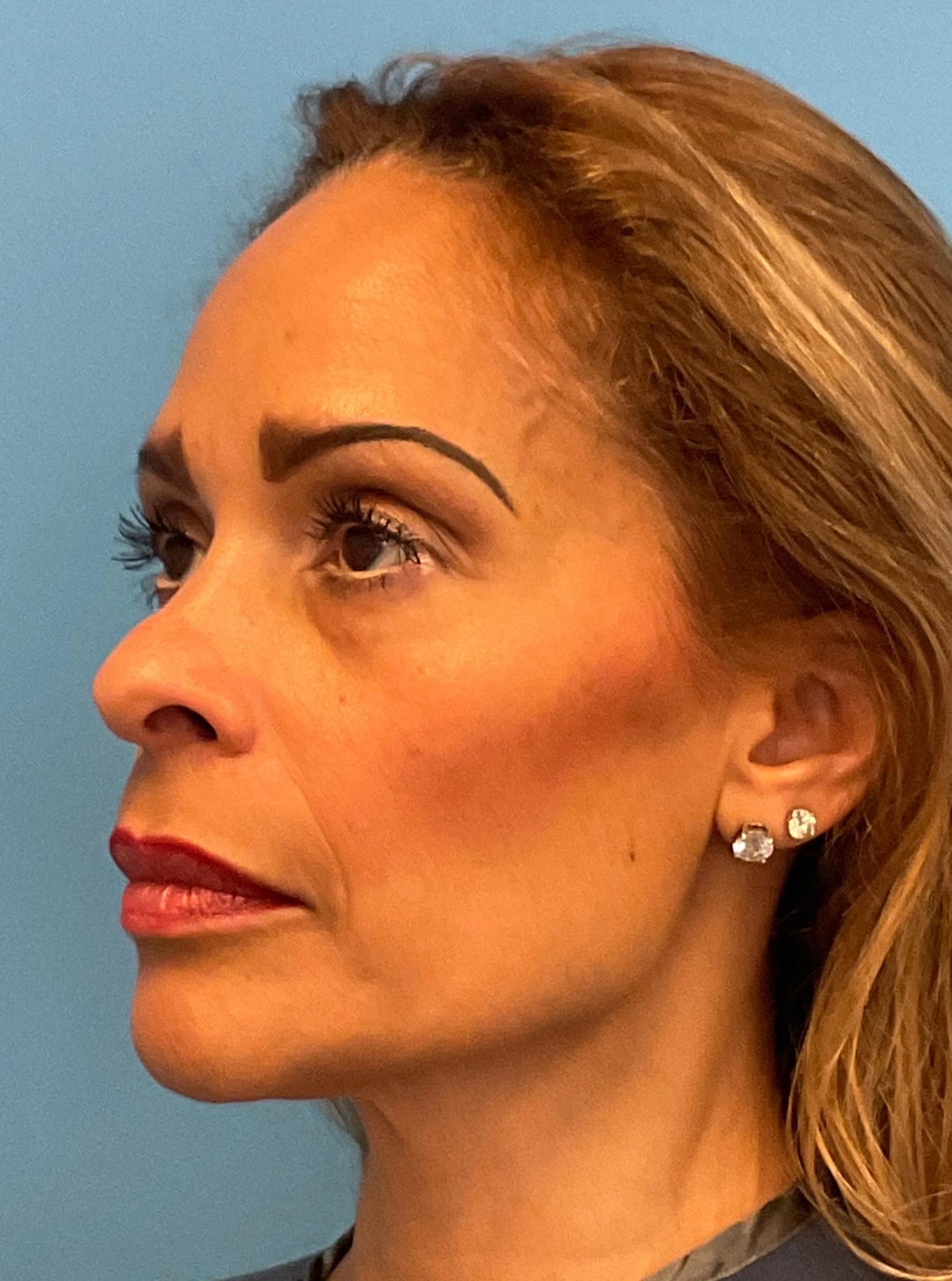 Facelift-and-Facial-Fat-Grafting-Case--4152 | Before Facelift 5