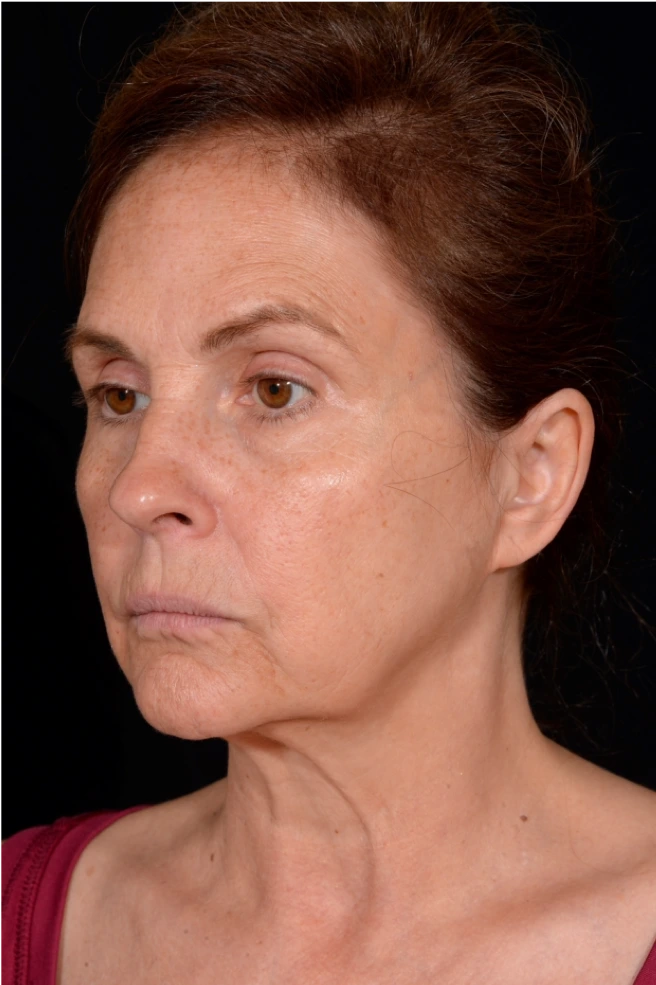 Facelift-Case--4160 | Before Facelift 5