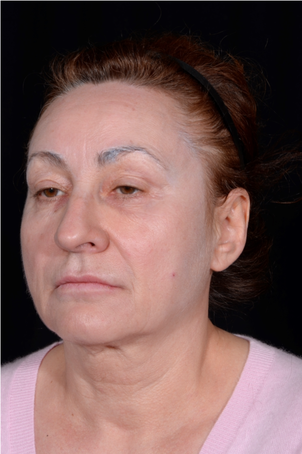 Face-and-Neck-Lift-Case--8423 | Before Facelift 3