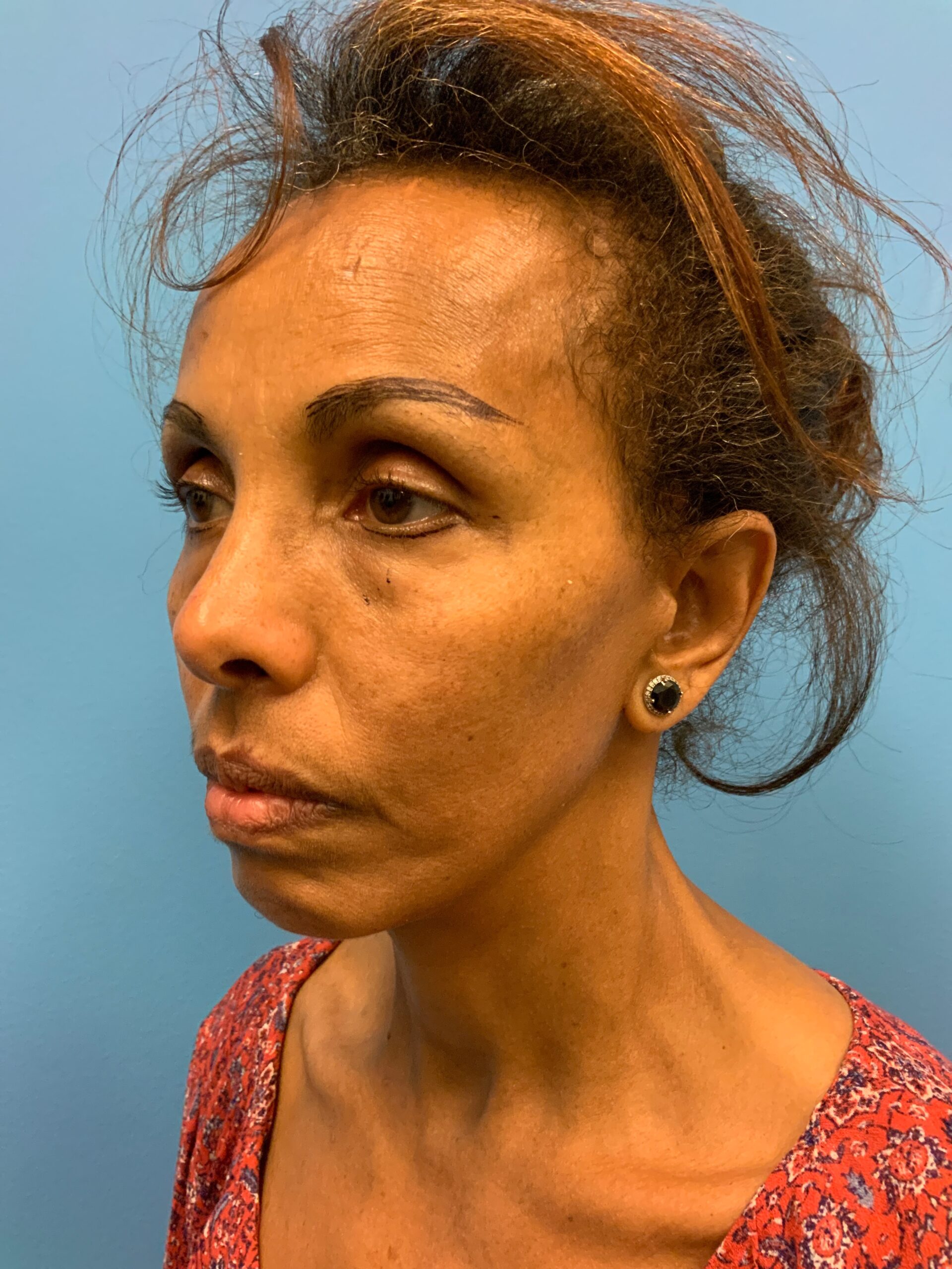 Facelift-Case--1863 | Before Facelift 5
