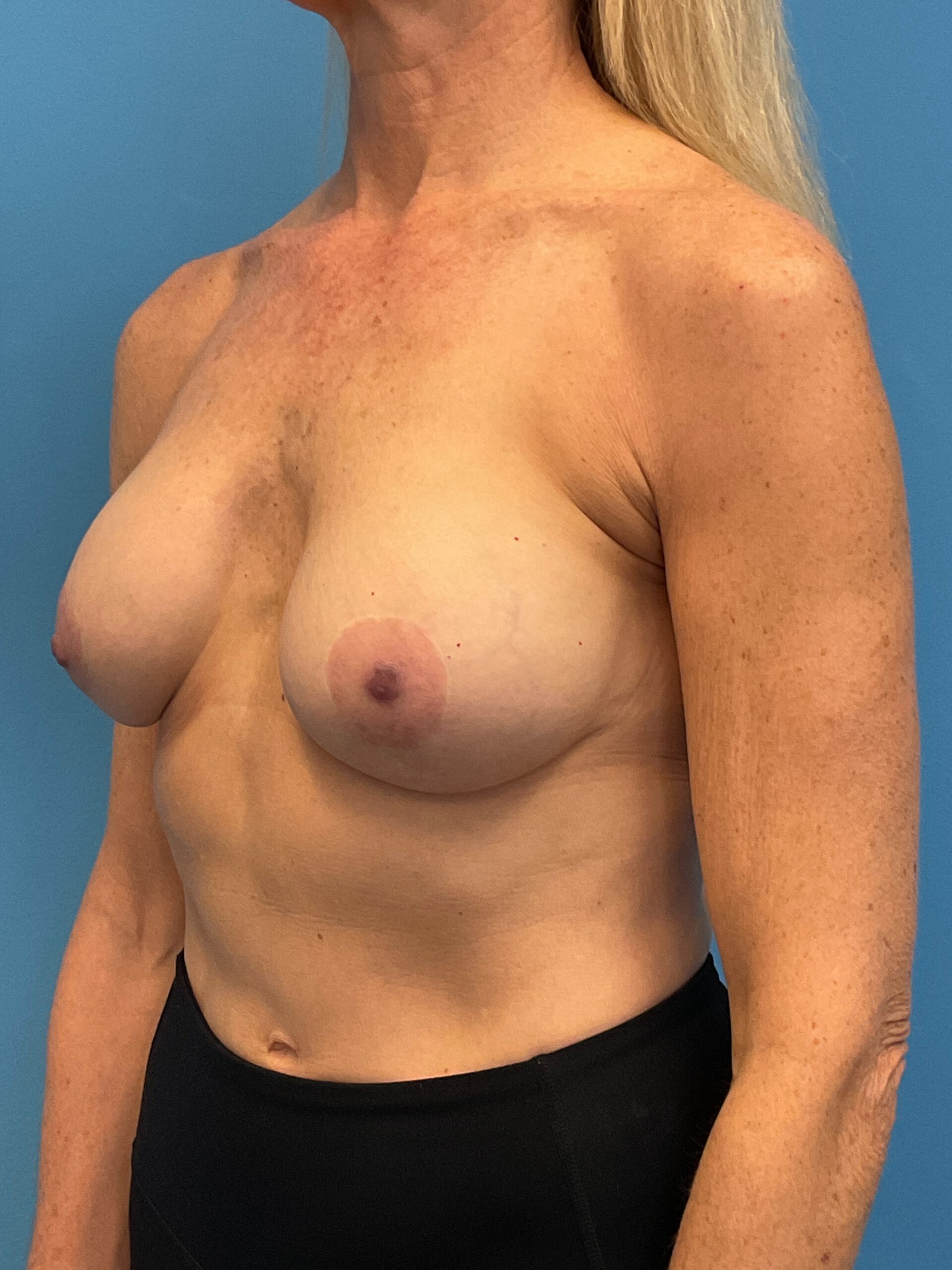 Revision-Breast-Augmentation-Case--9027 | Before Revision Augmentation 5
