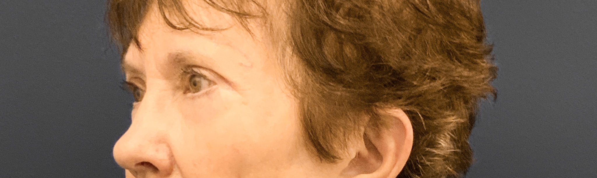 Blepharoplasty-Case--3418 | Before Eyelid Surgery 4