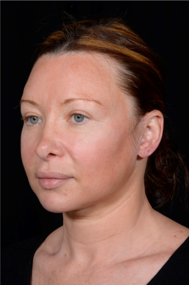 Facelift-and-Facial-Fat-Grafting-Case--1679 | Before Facelift 3