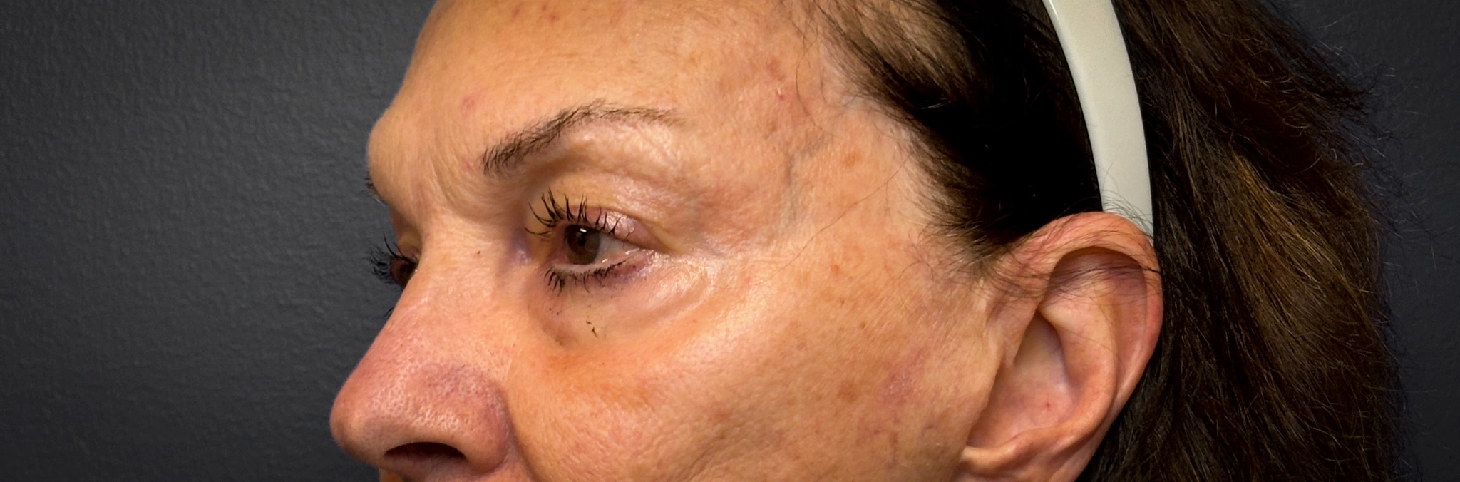 Upper-Blepharoplasty-Case--2075 | Before Eyelid Surgery 3