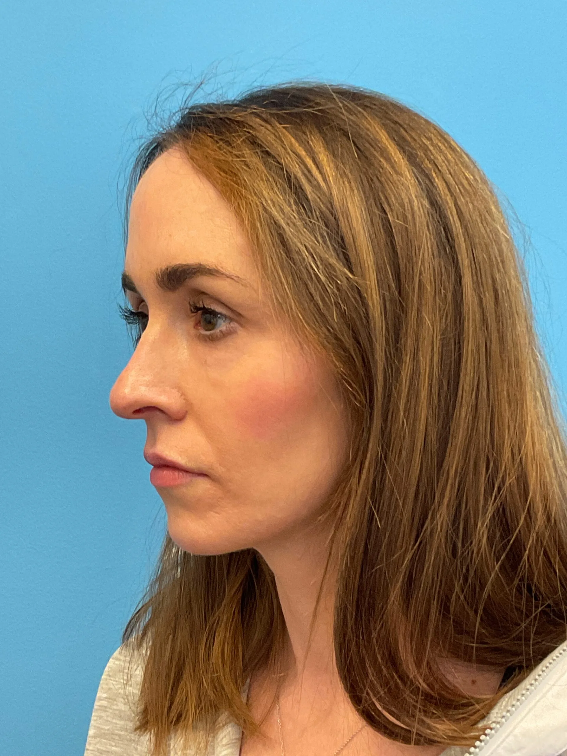 Rhinoplasty-Case--1281 | Before Rhinoplasty 5