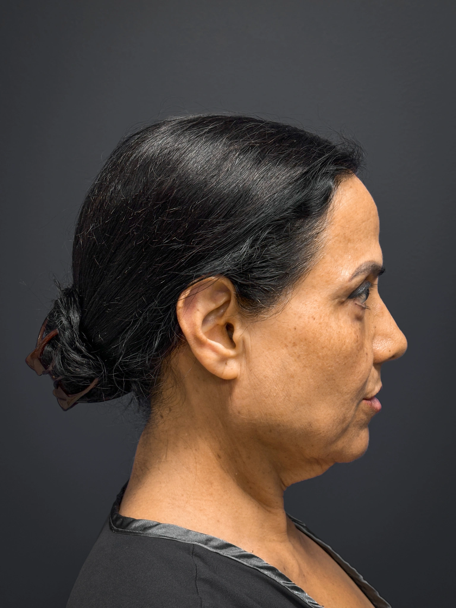Facelift-and-Facial-Fat-Grafting-Case--8416 | Before Facelift 2
