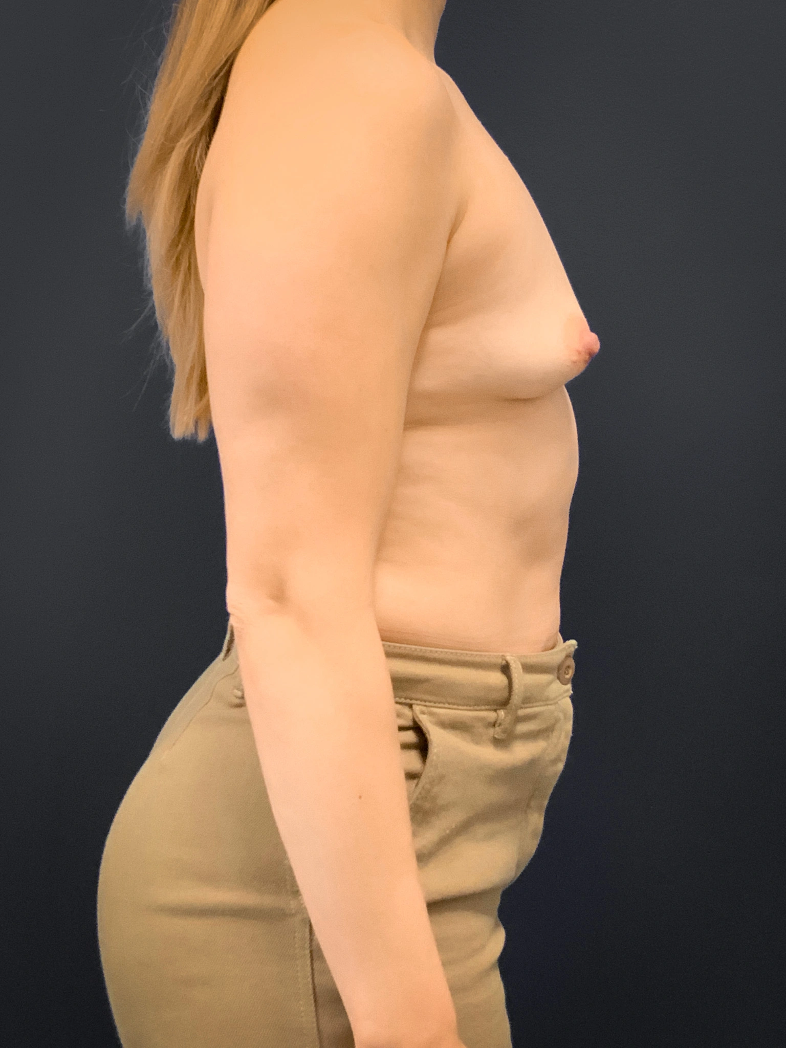 Breast-Augmentation-Case--2225 | Before Breast 2