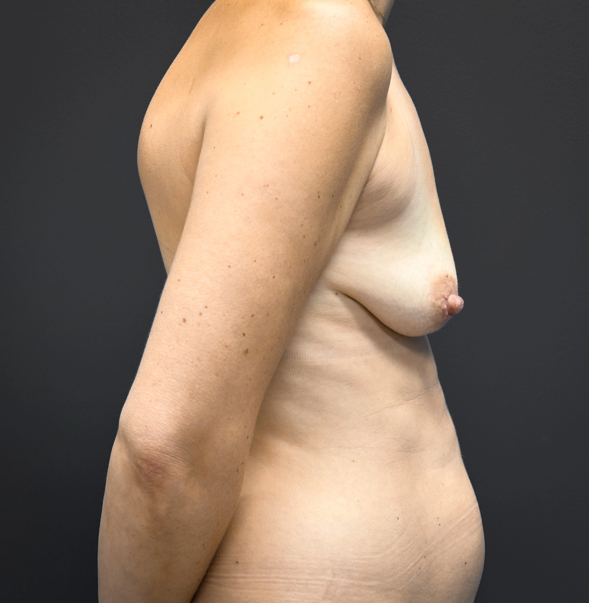 Breast-Augmentation-Case--7139 | Before Breast 2