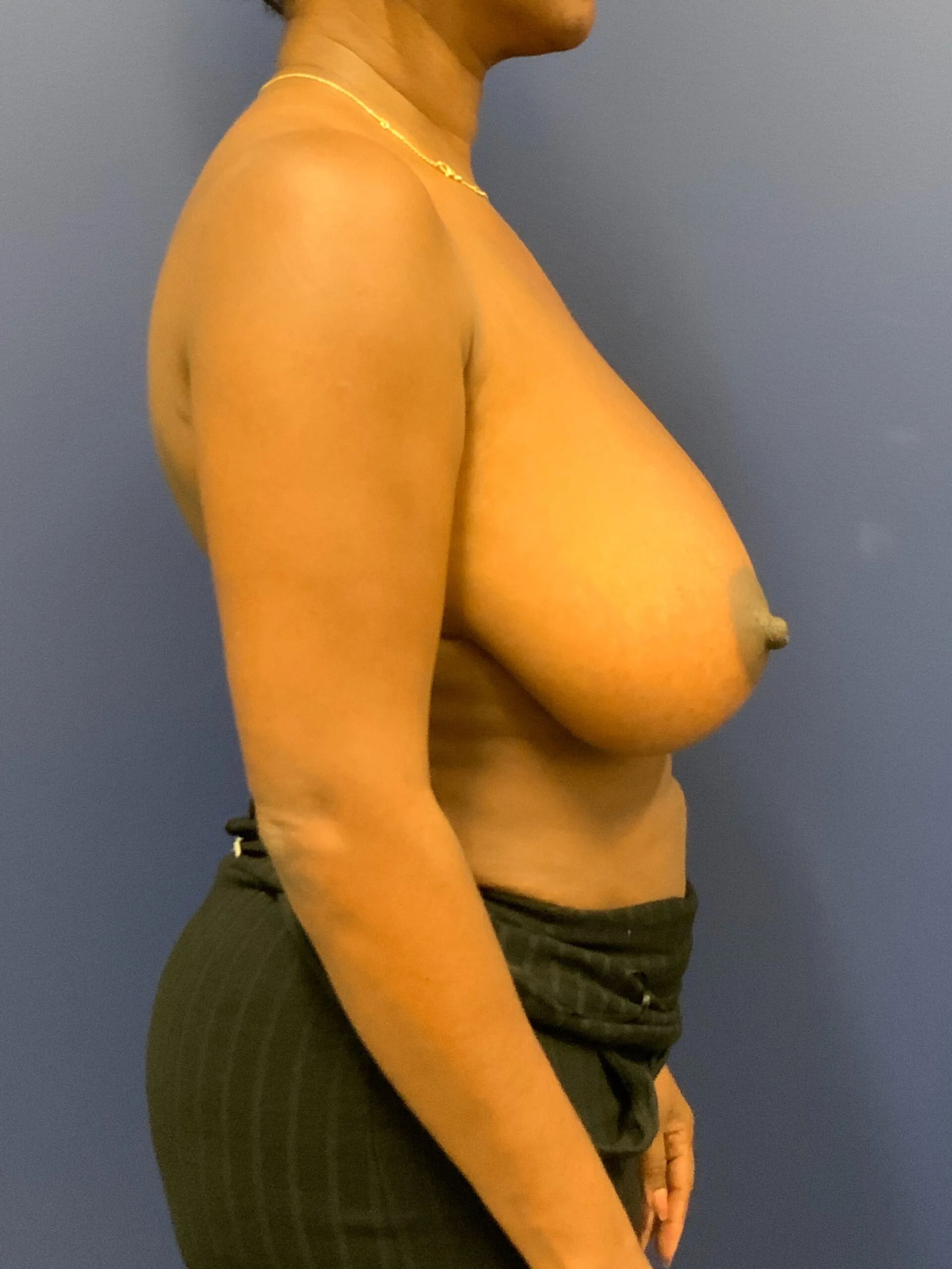 Breast-Reduction-Case--9689 | Before Breast 2