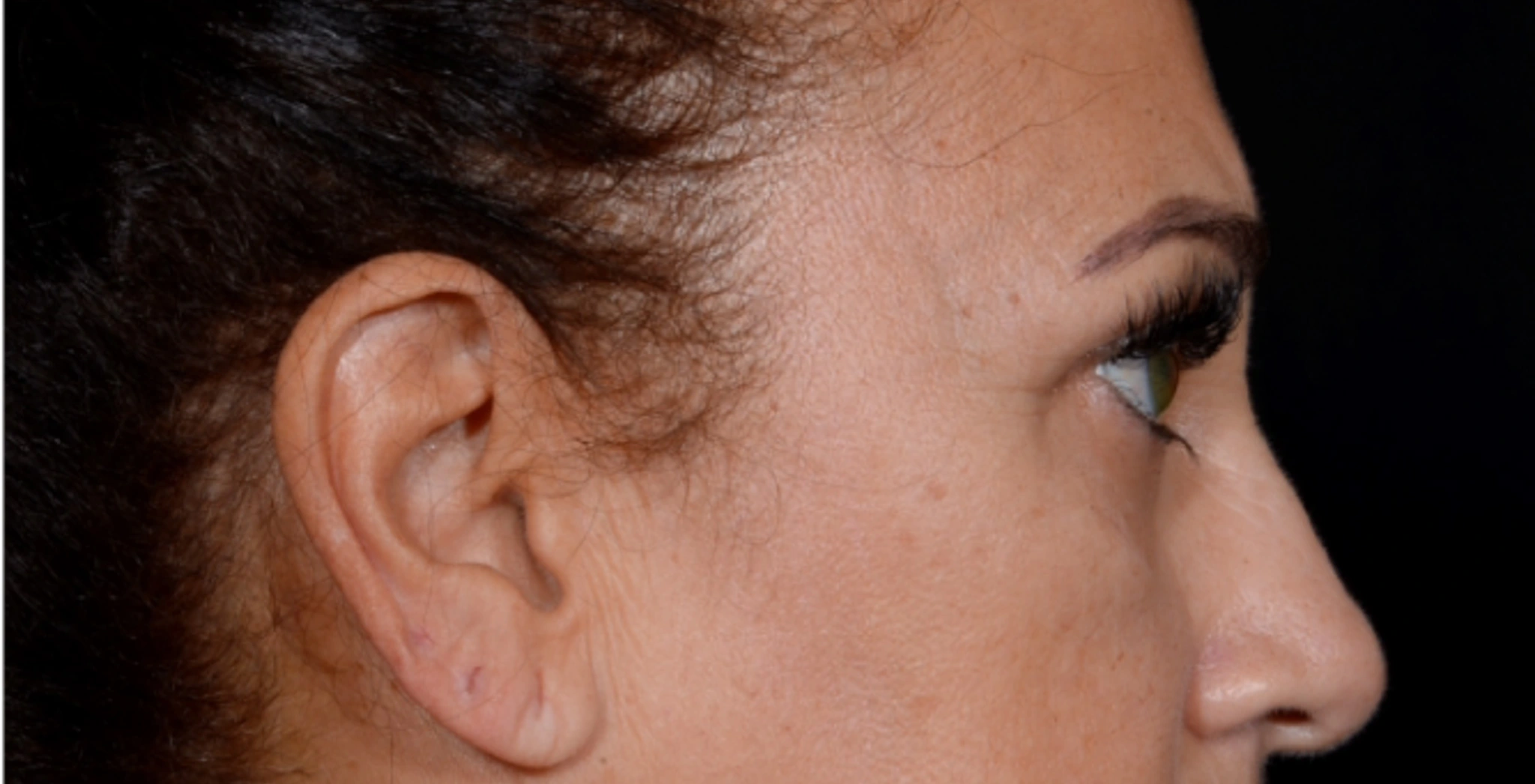 Brow-Lift-Case--6540 | Before Brow Lift 2