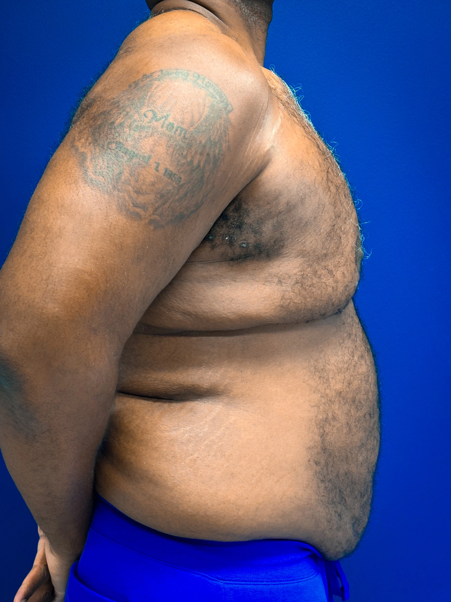 Gynecomastia-Case--4473 | Before Breast 2