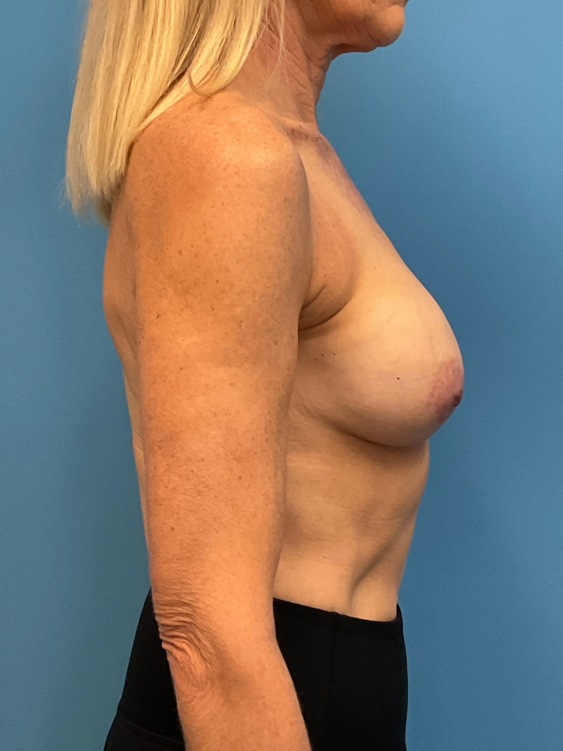 Augmentation-Mastopexy-Case--1505 | Before Breast 2