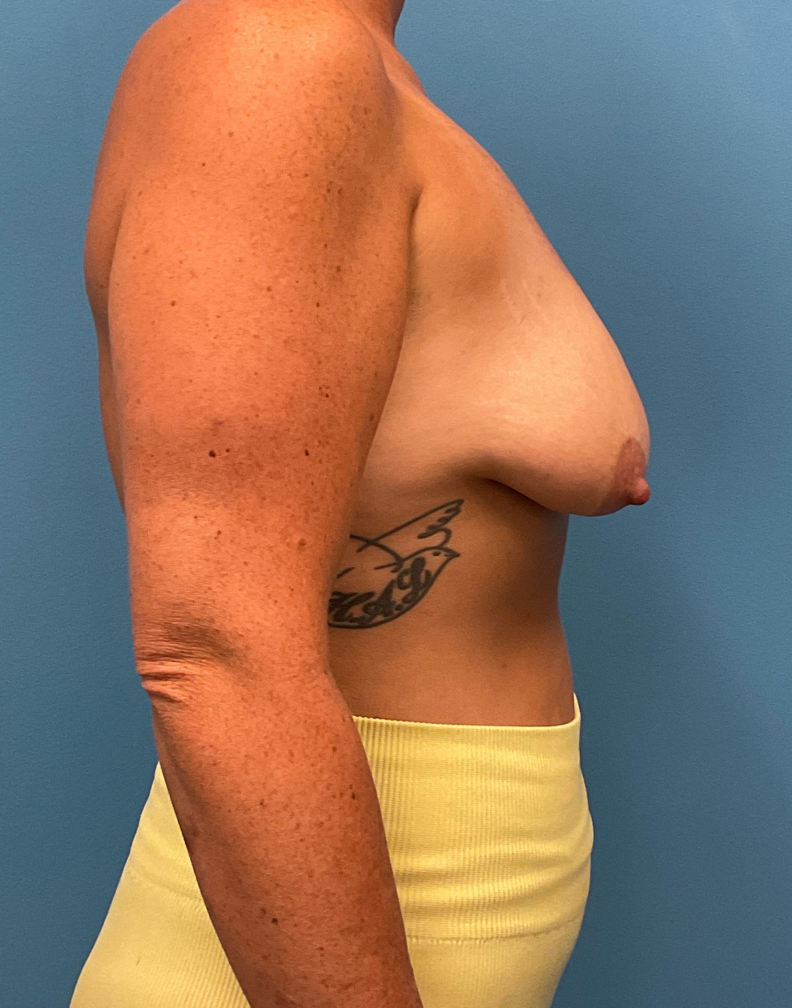 Augmentation-Mastopexy-Case--6355 | Before Breast 2