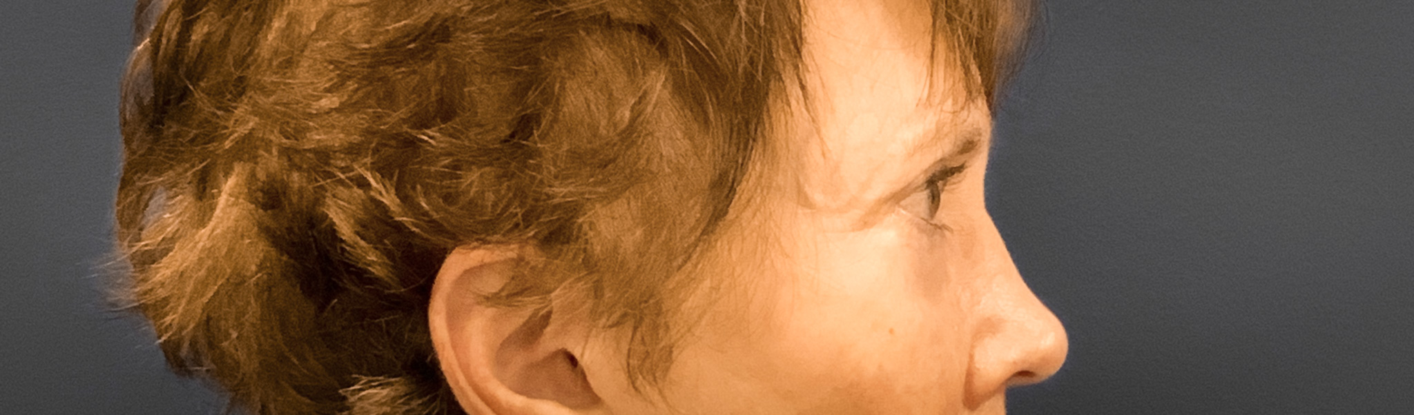 Blepharoplasty-Case--3418 | Before Eyelid Surgery 3