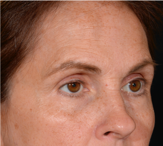Quad-Blepheroplasty-Case--5361 | Before Eyelid Surgery 2