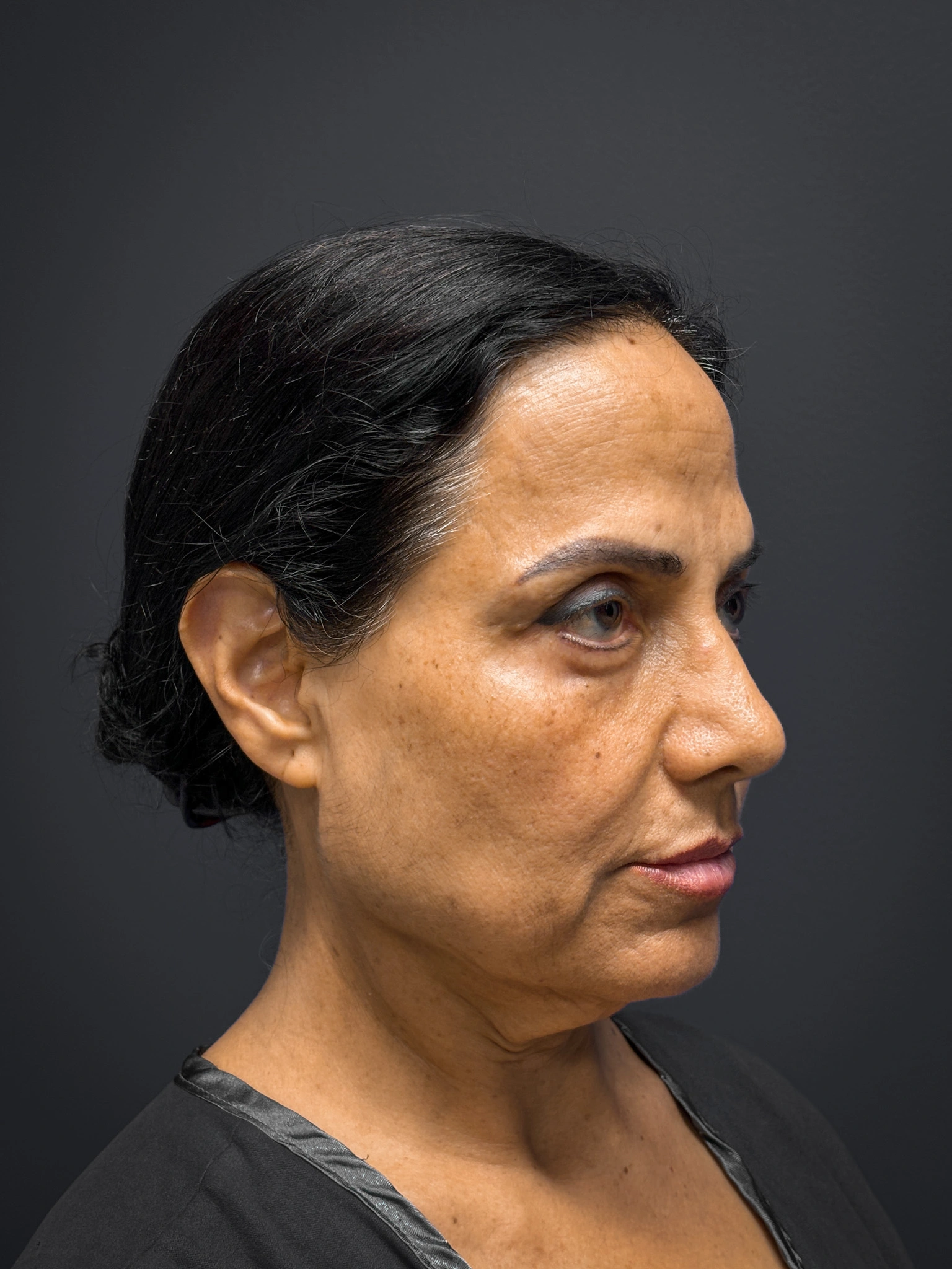 Facelift-and-Facial-Fat-Grafting-Case--8416 | Before Facelift 4