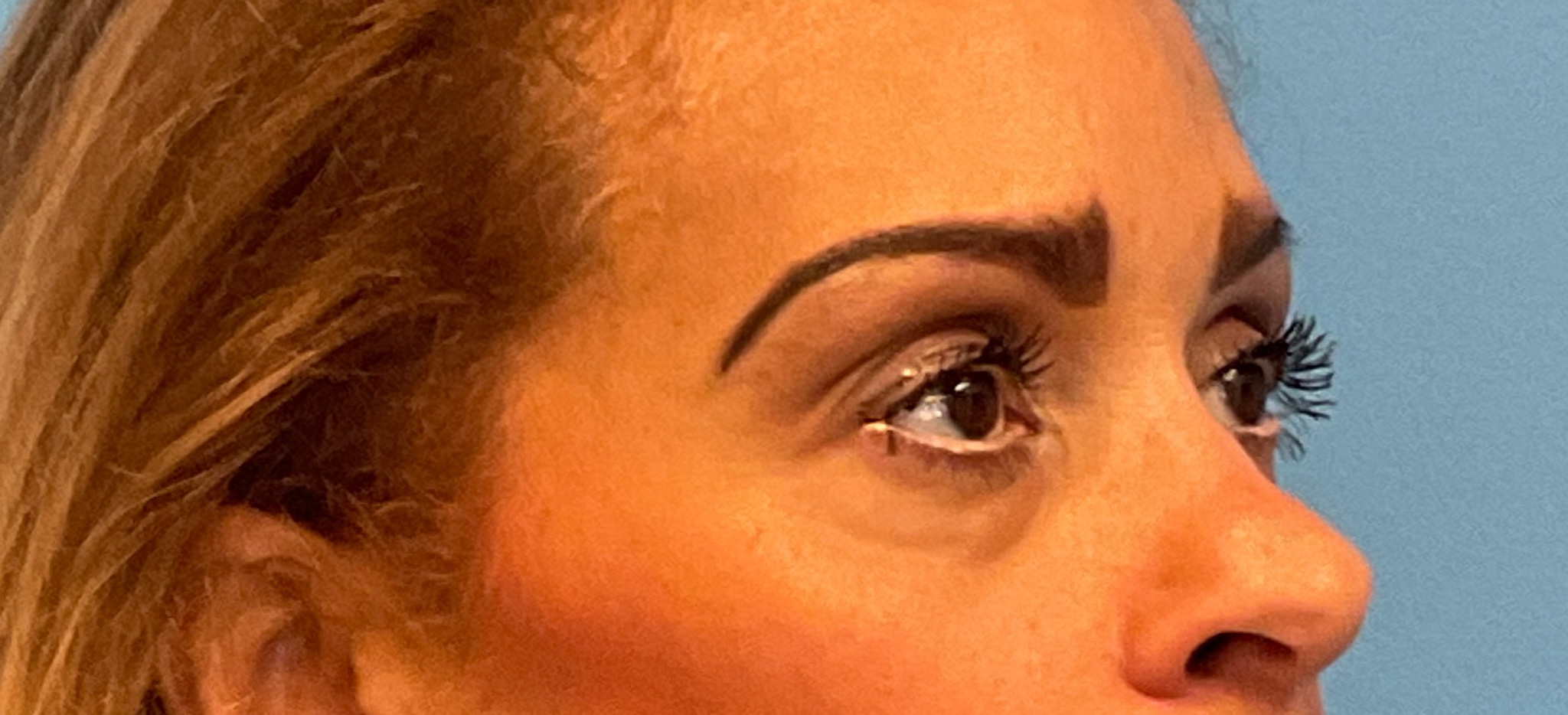 Quad-Blepharoplasty-Case--1261 | Before Eyelid Surgery 4