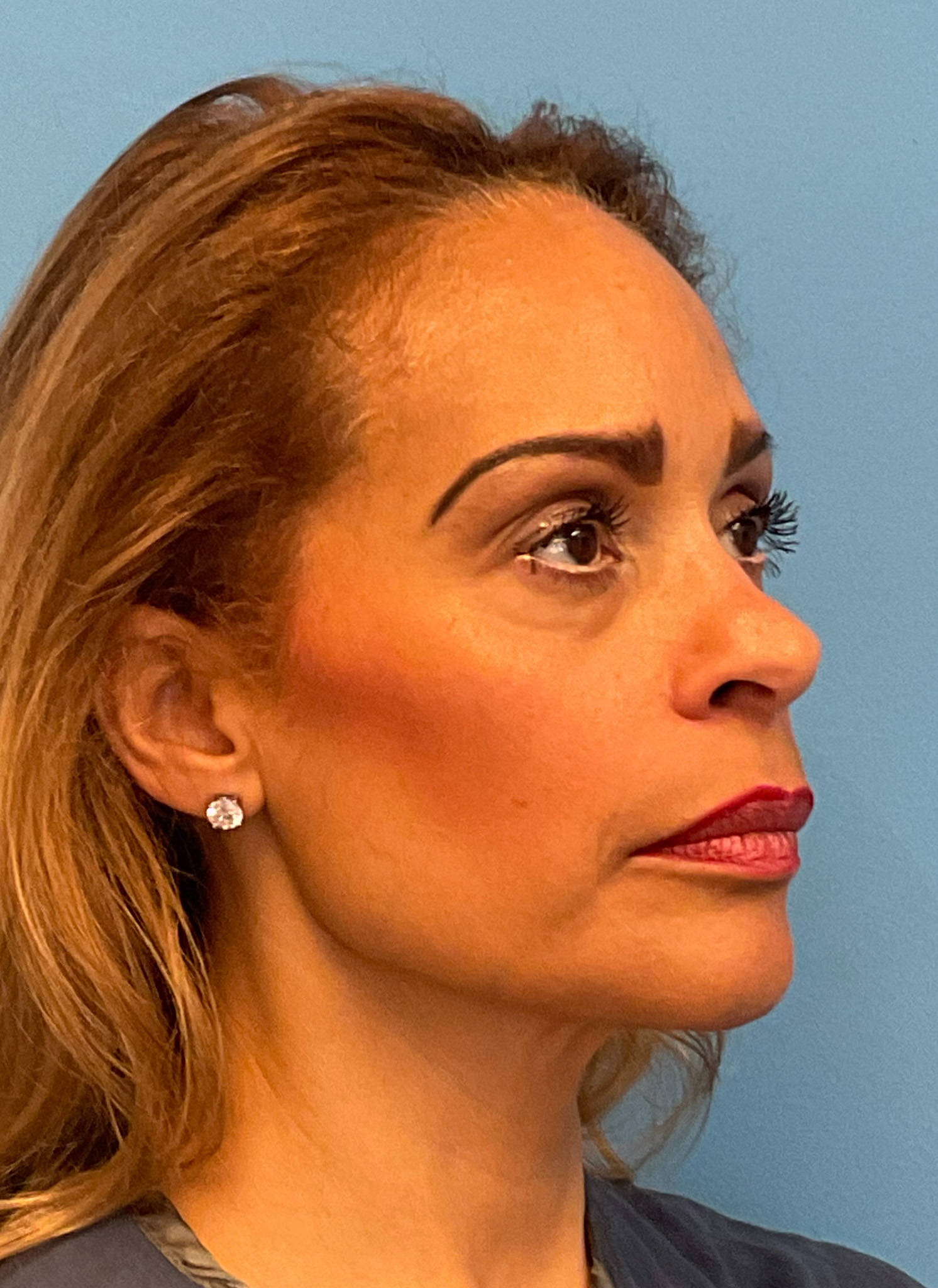 Facelift-and-Facial-Fat-Grafting-Case--4152 | Before Facelift 4