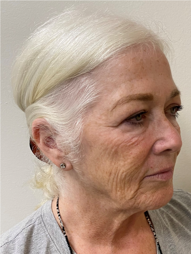 Face-and-Neck-Case--1975 | Before Neck Lift 2