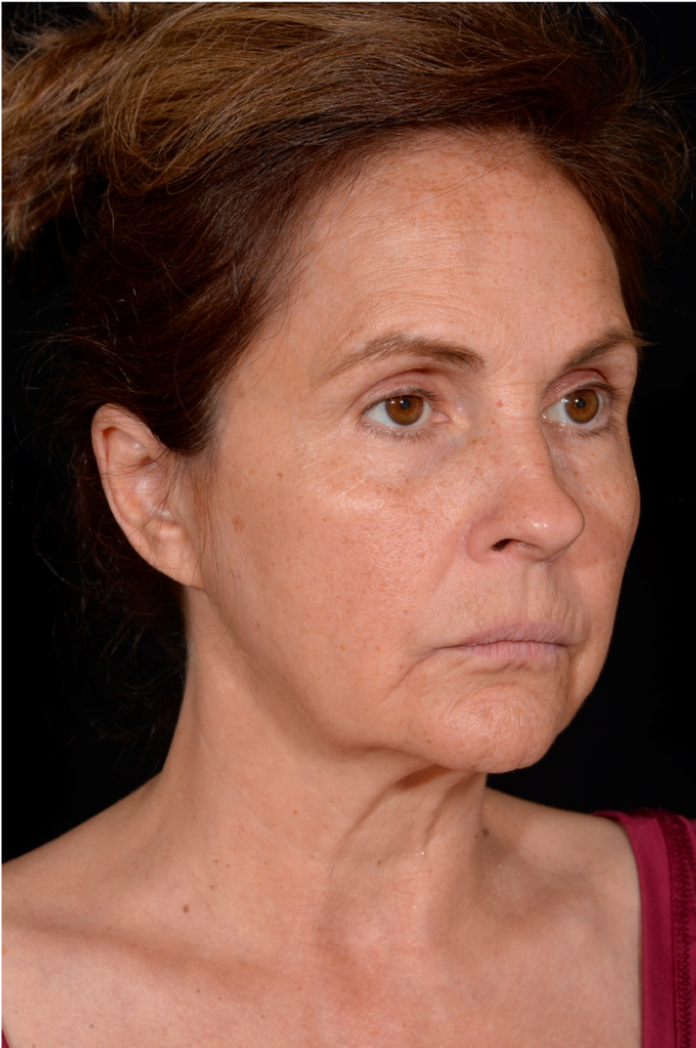 Facelift-Case--4160 | Before Facelift 4