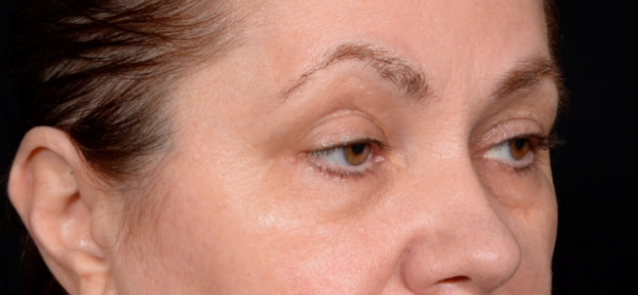 Quad-Blepharoplasty-Case--1851 | Before Eyelid Surgery 3