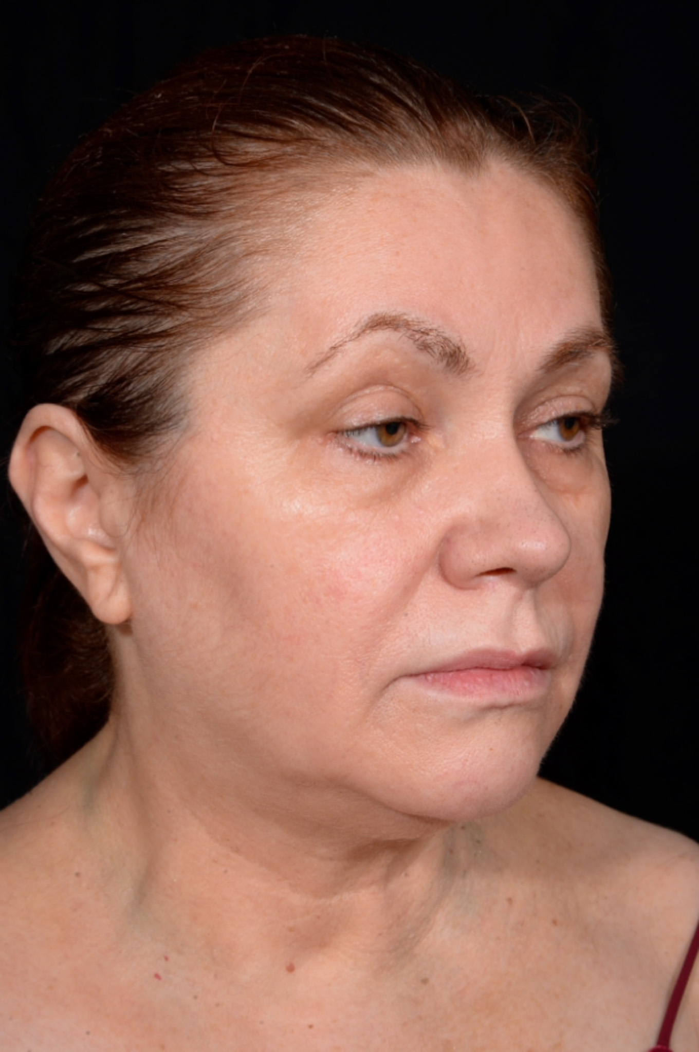 Facelift-Case--6254 | Before Facelift 3