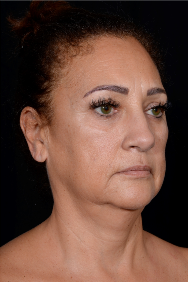 Rhinoplasty-Case--8713 | Before Rhinoplasty 3