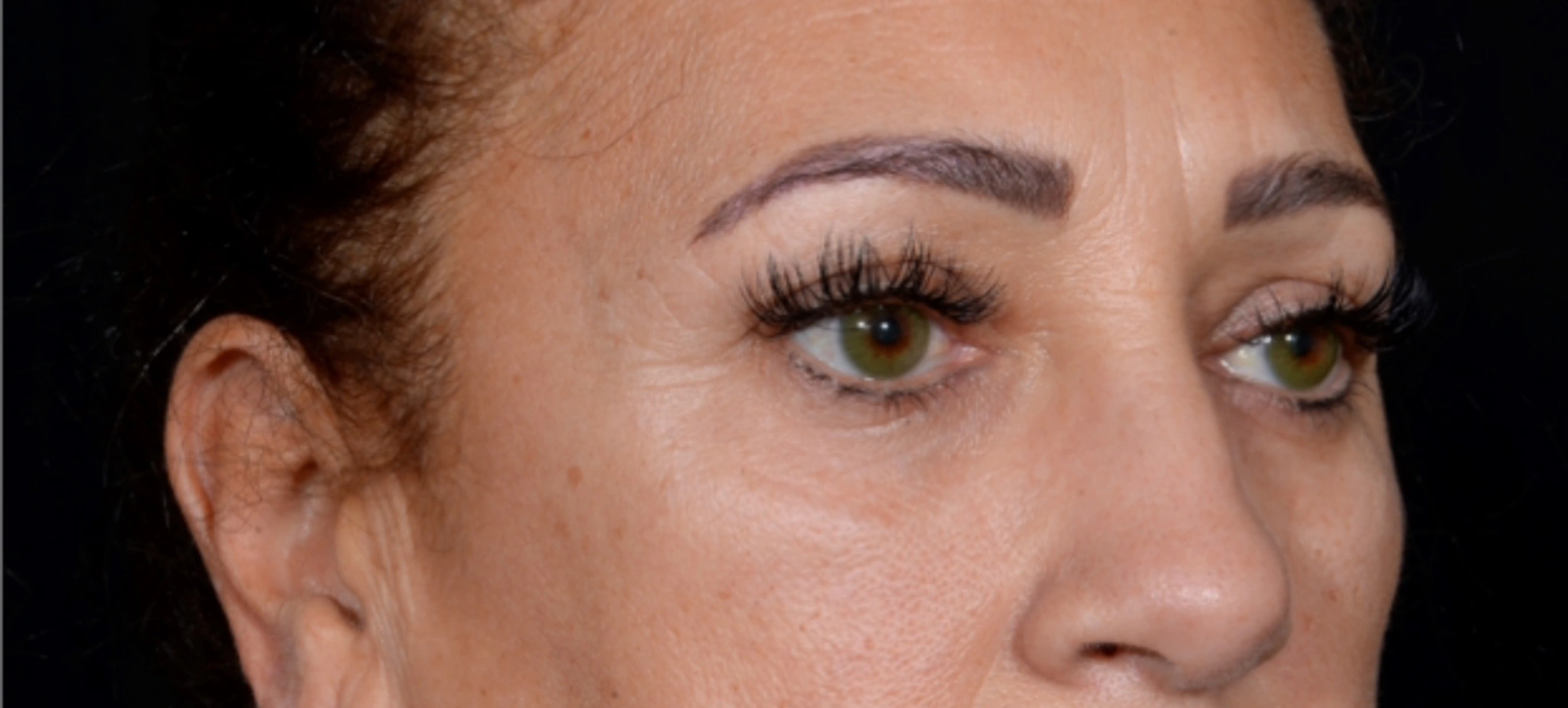 Quad-Blepharoplasty-Case--2302 | Before Eyelid Surgery 3