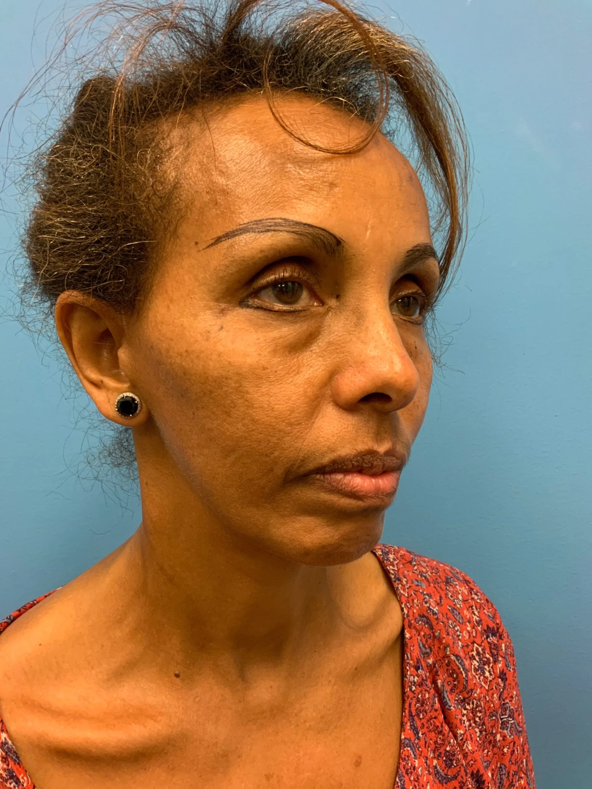 Facelift-Case--1863 | Before Facelift 4