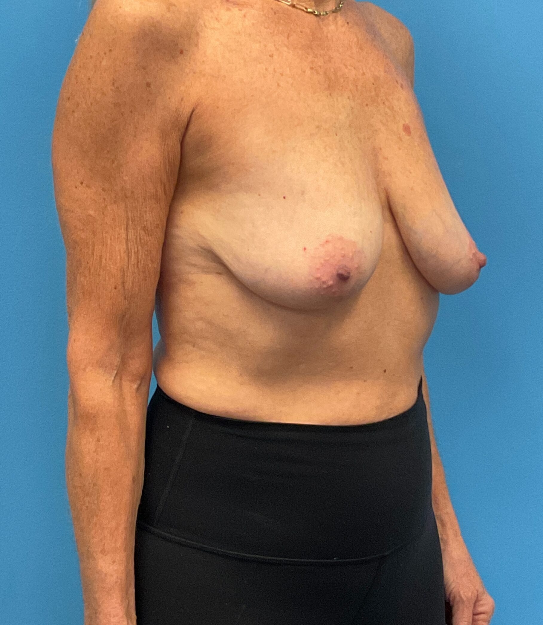 Mastopexy-Case--9216 | Before Breast Lift 5