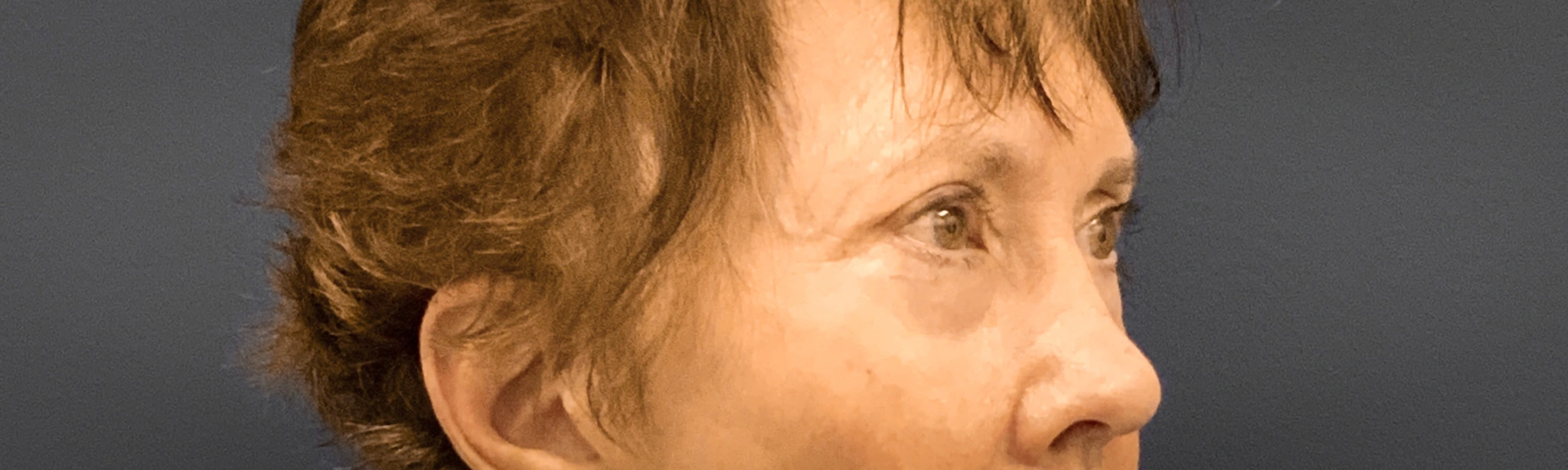 Blepharoplasty-Case--3418 | Before Eyelid Surgery 5