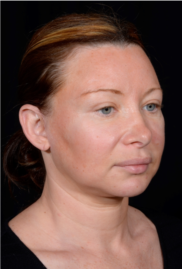 Facelift-and-Facial-Fat-Grafting-Case--1679 | Before Facelift 4
