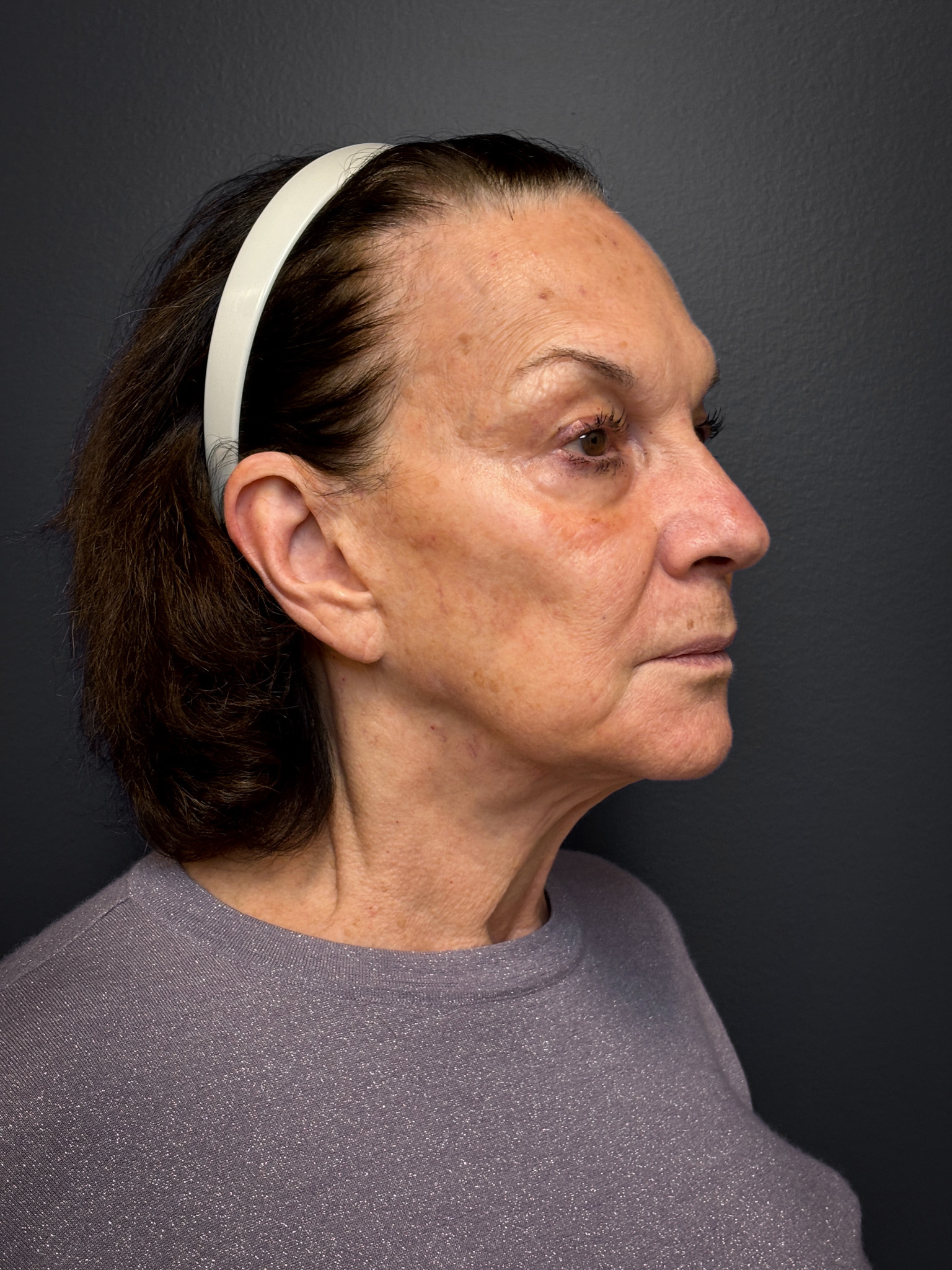 Revision-Facelift-Case--3082 | Before Facelift 3