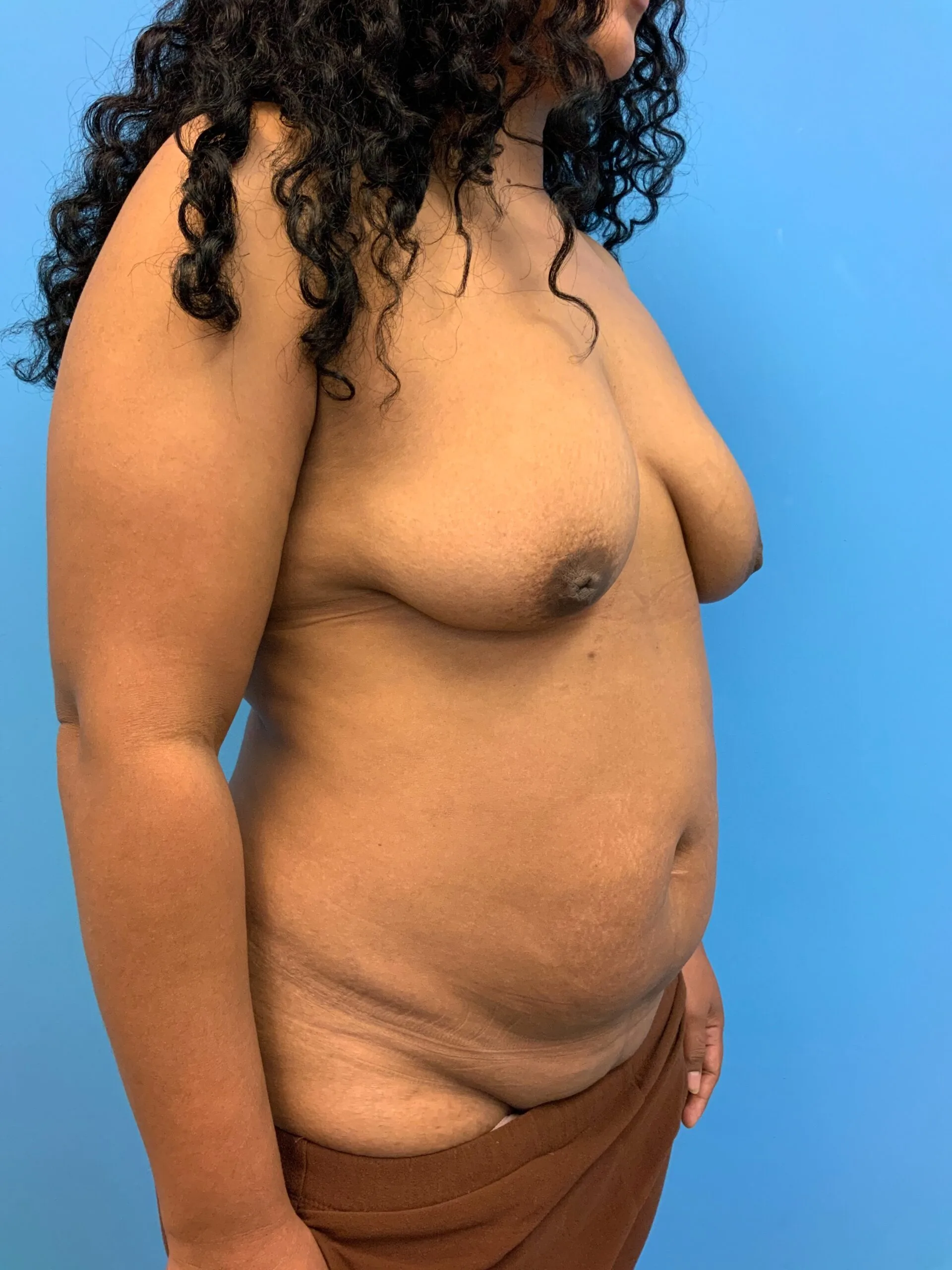 Abdominoplasty-Case--1110 | Before Tummy Tuck 4