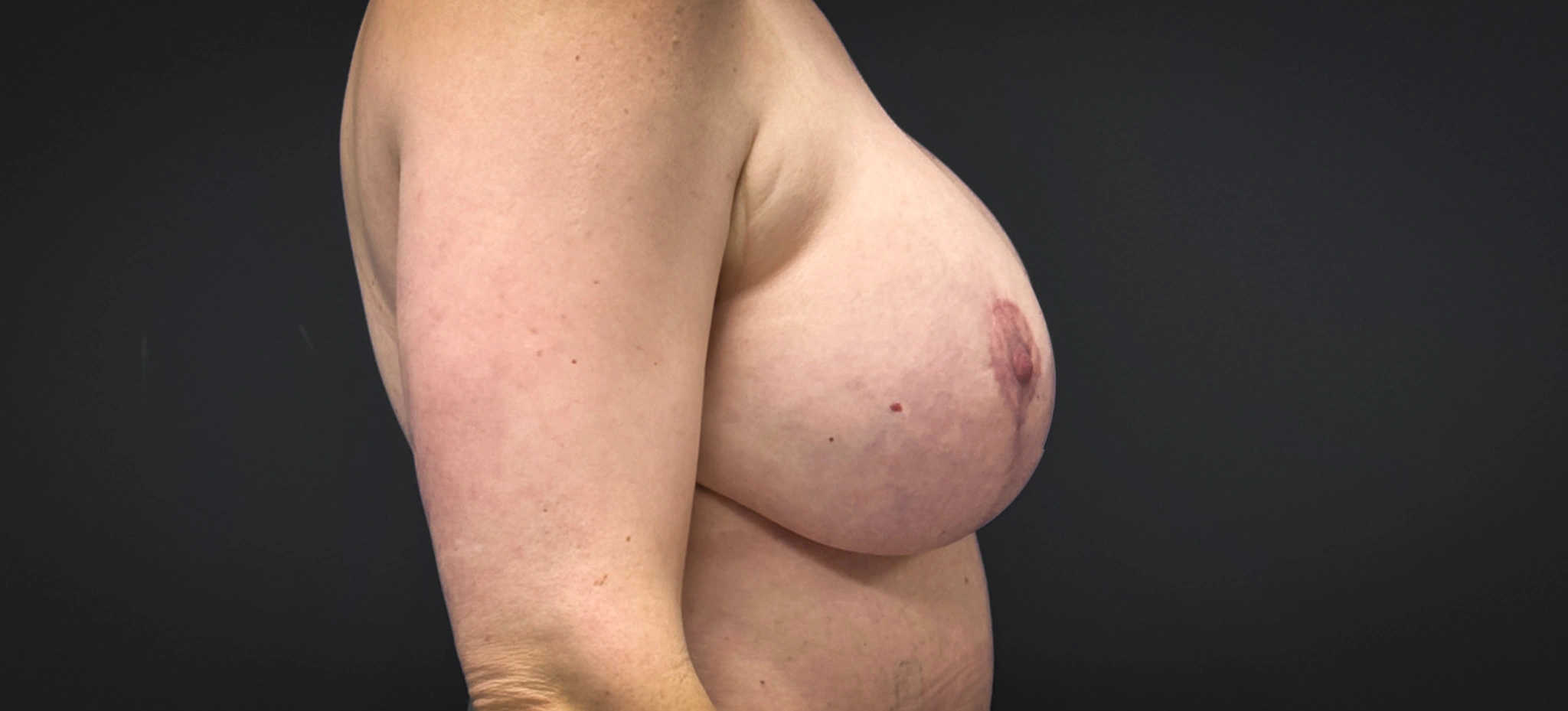 Augmentation-Mastopexy-Case--2453 | After Breast 2