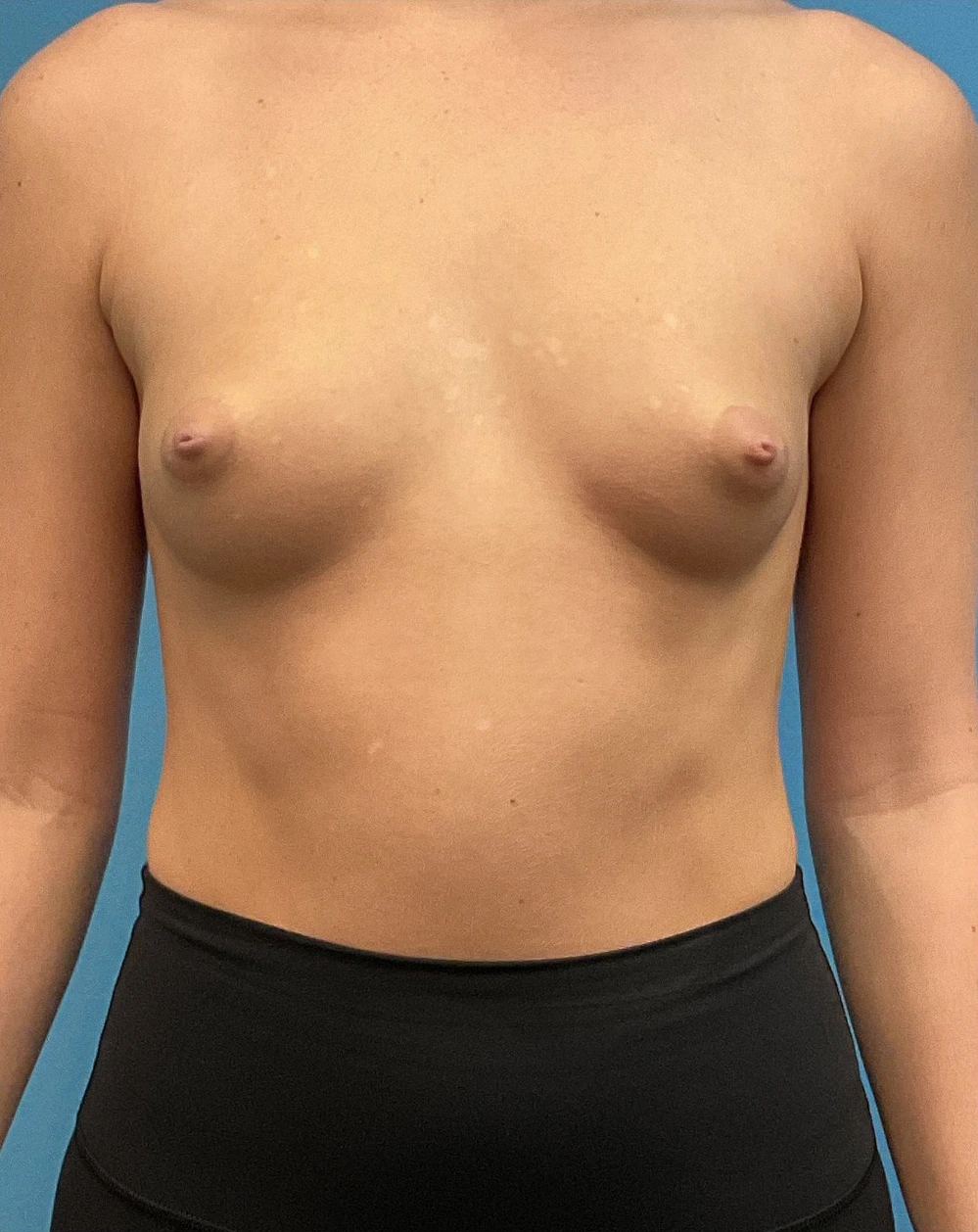Breast-Augmentation-Case--28179 | Before Breast 1