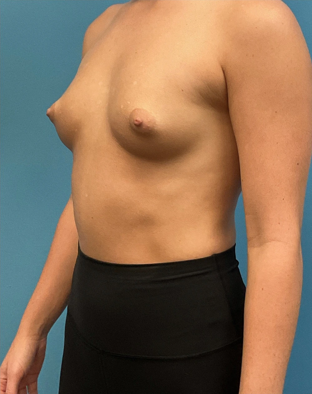 Breast-Augmentation-Case--28179 | Before Breast 2