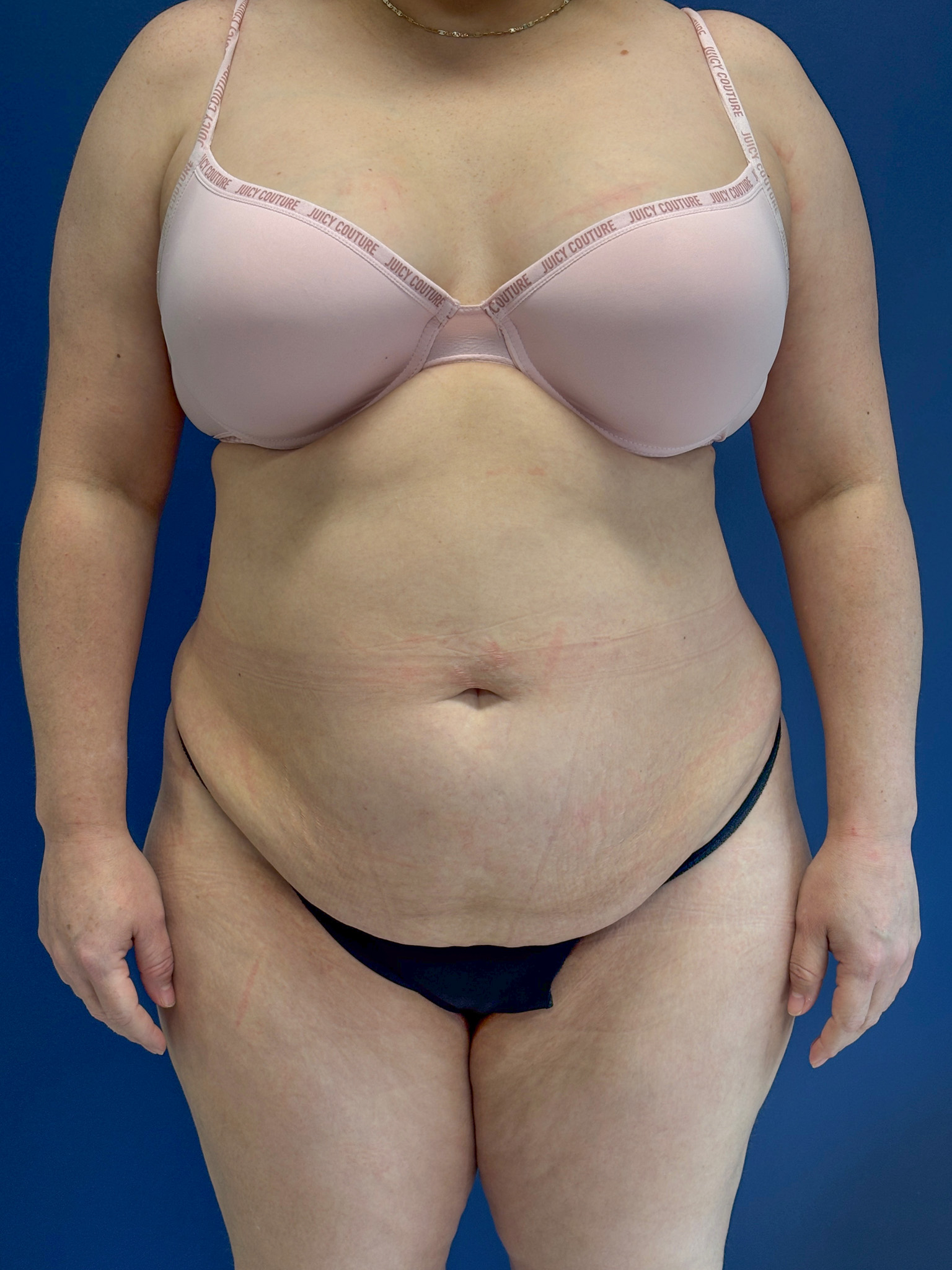 Brazilian-Butt-Lift-Case--9569 | Before Brazilian Butt Lift 4