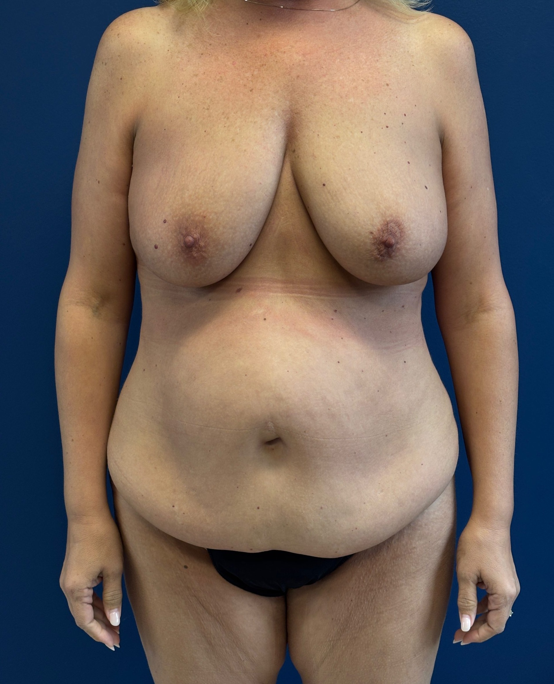 Abdominoplasty-Case--9829 | Before Tummy Tuck 1