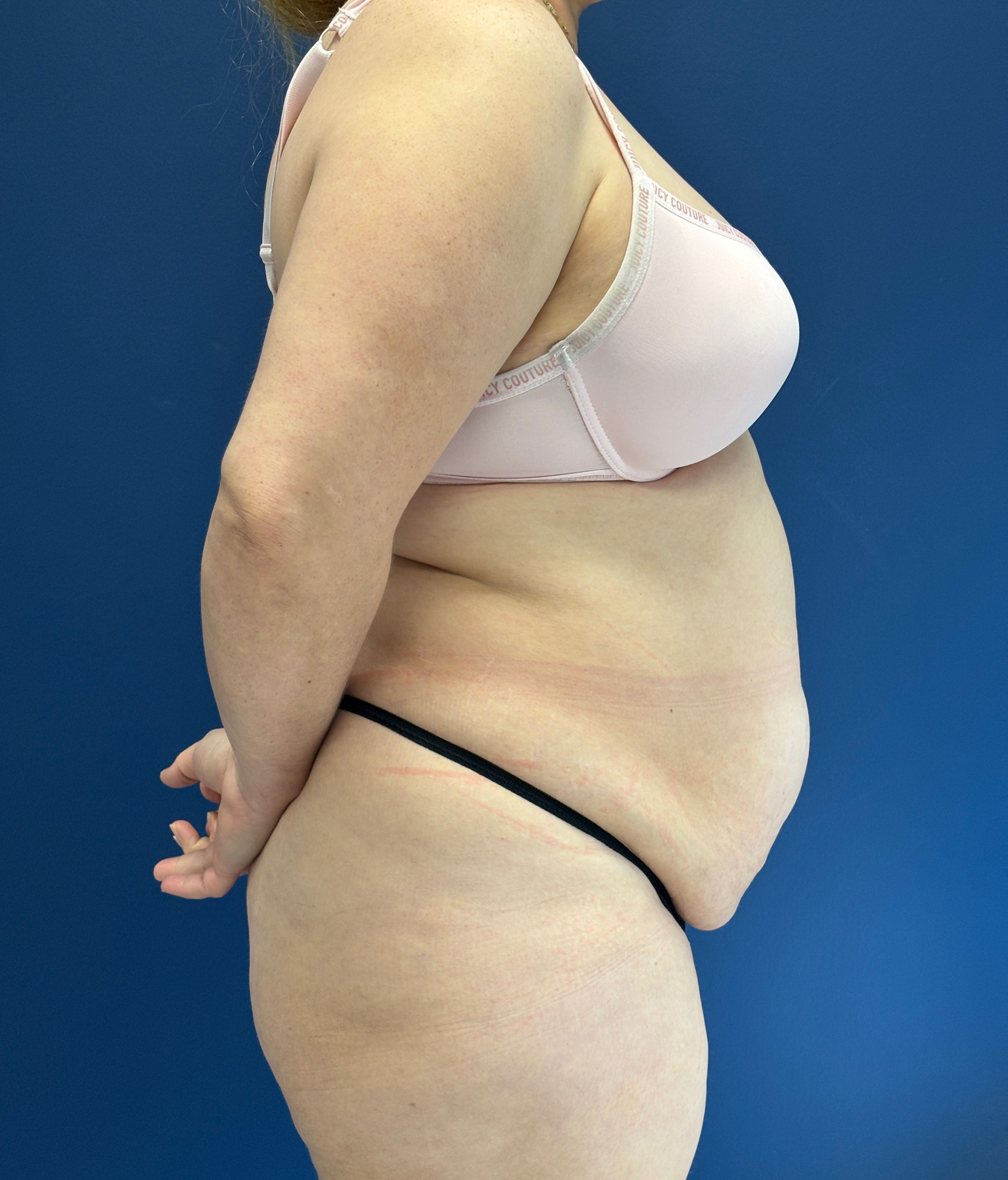 Brazilian-Butt-Lift-Case--9569 | Before Brazilian Butt Lift 3
