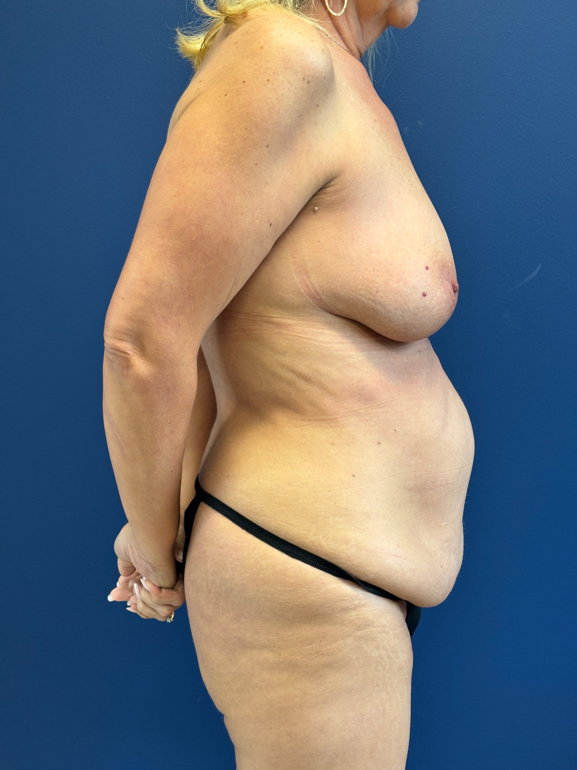 Abdominoplasty-Case--6263 | Before Tummy Tuck 3