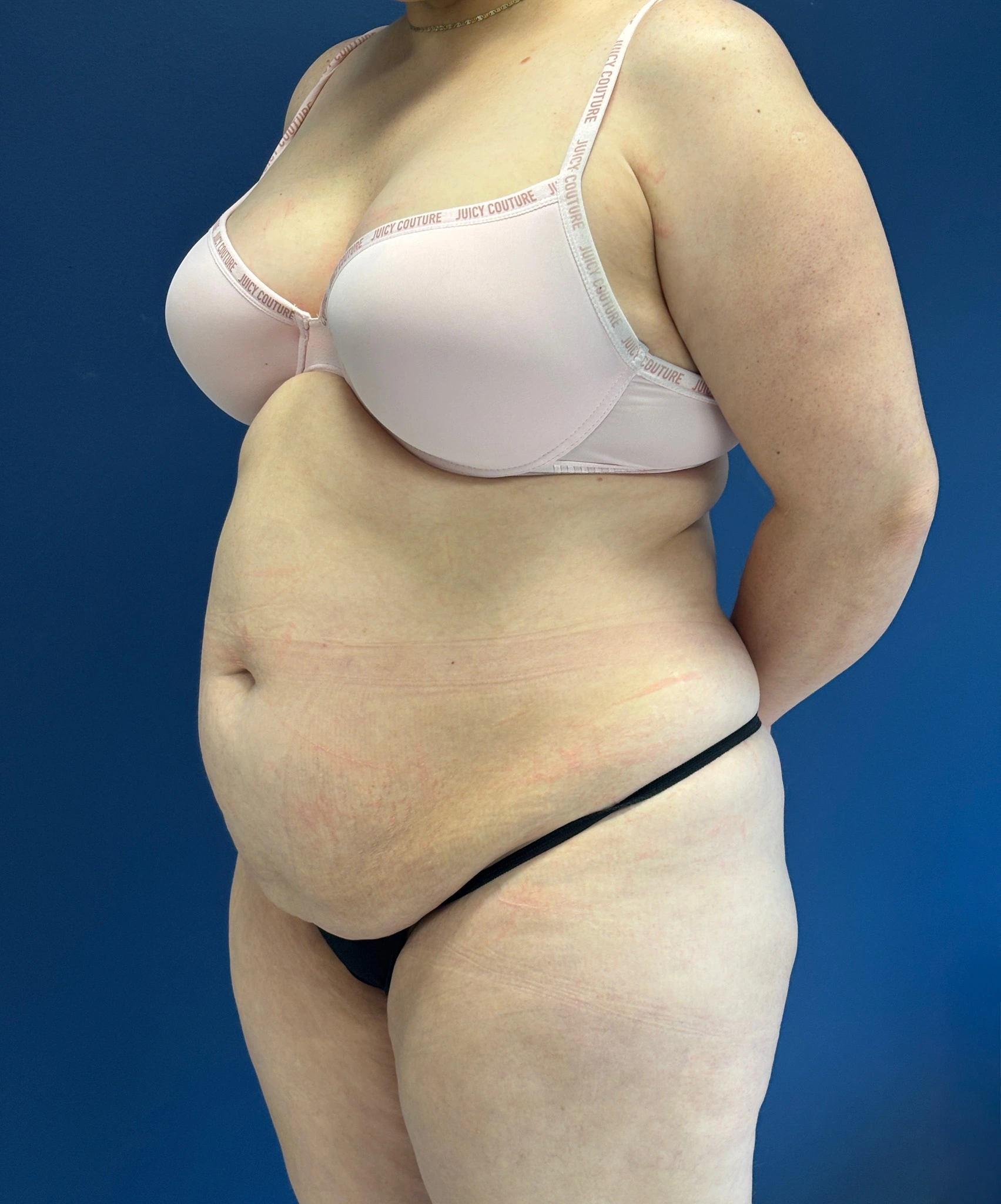 Abdominoplasty-Case--1259 | Before Tummy Tuck 5