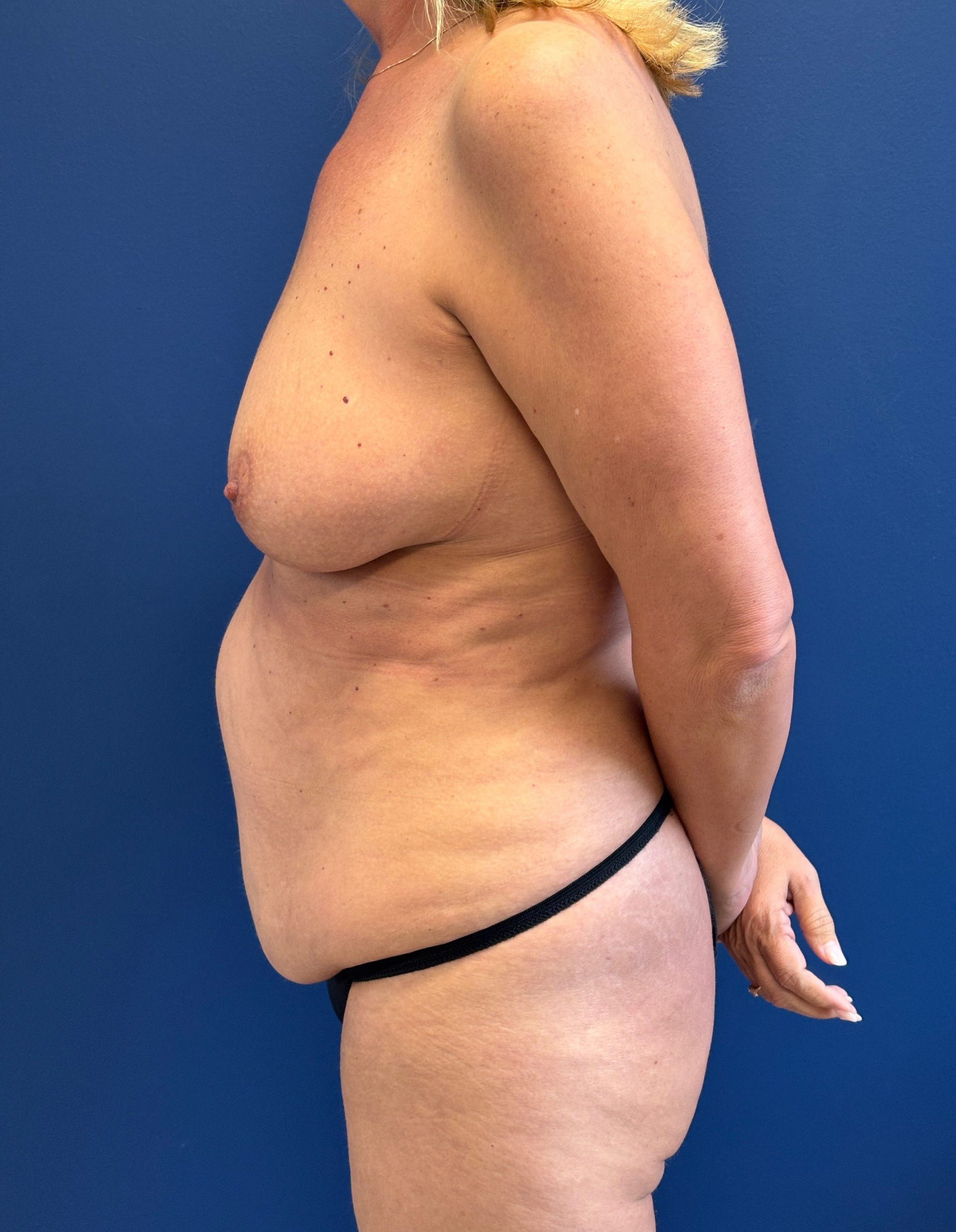 Abdominoplasty-Case--9829 | Before Tummy Tuck 2
