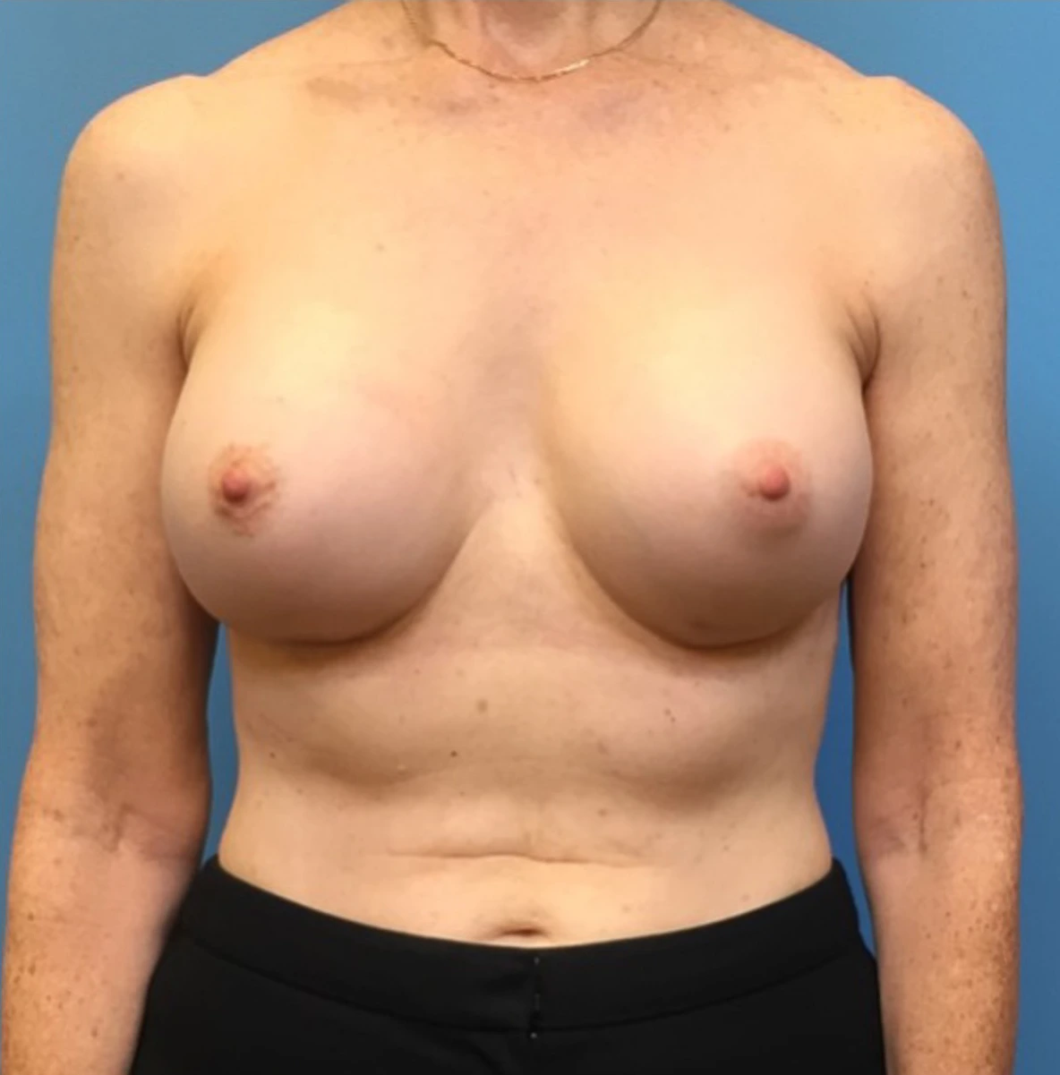 Revision-Augmentation-Case--236 | After Breast 1