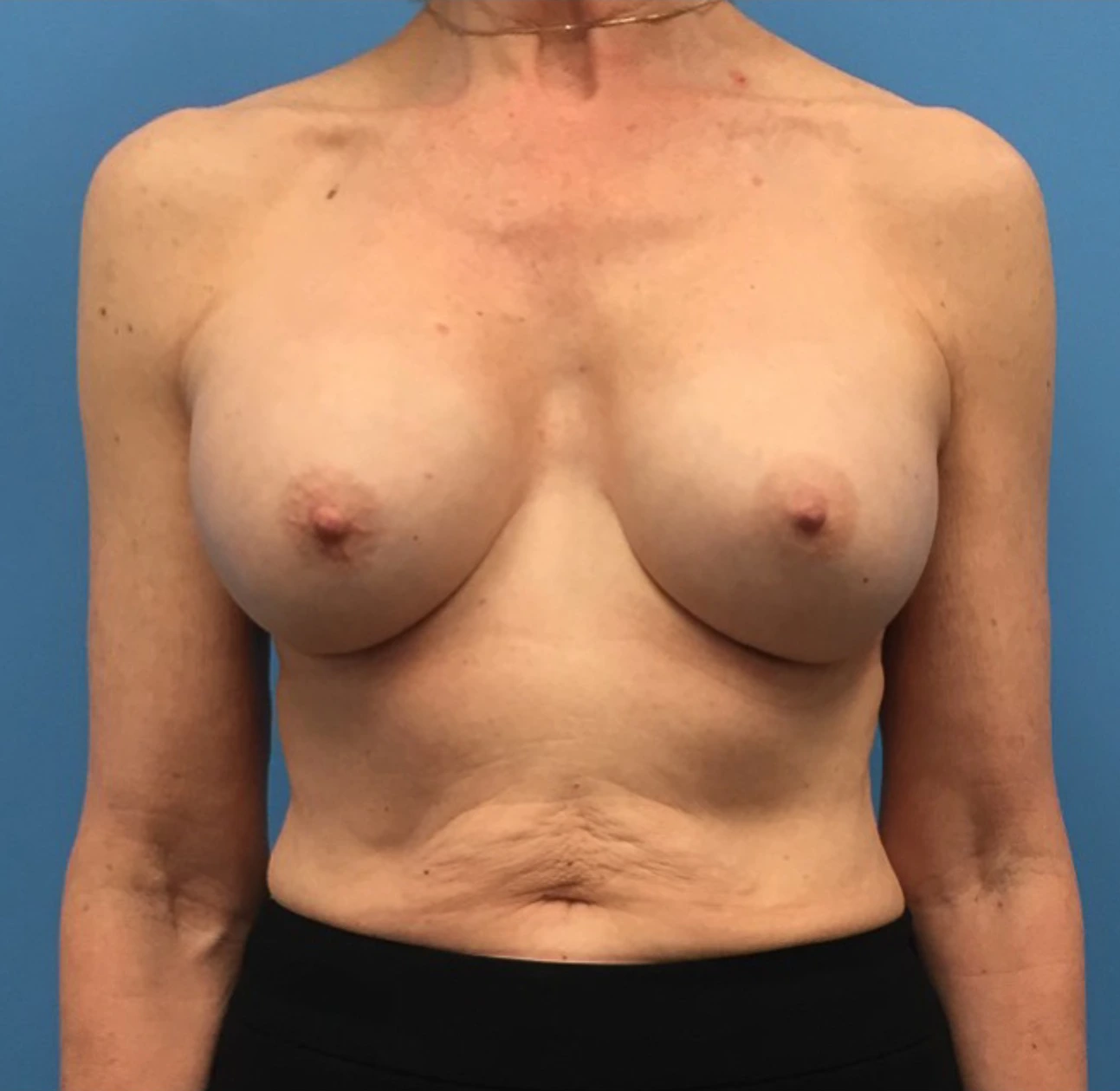 Revision-Breast-Augmentation-Case--237 | After Breast 1
